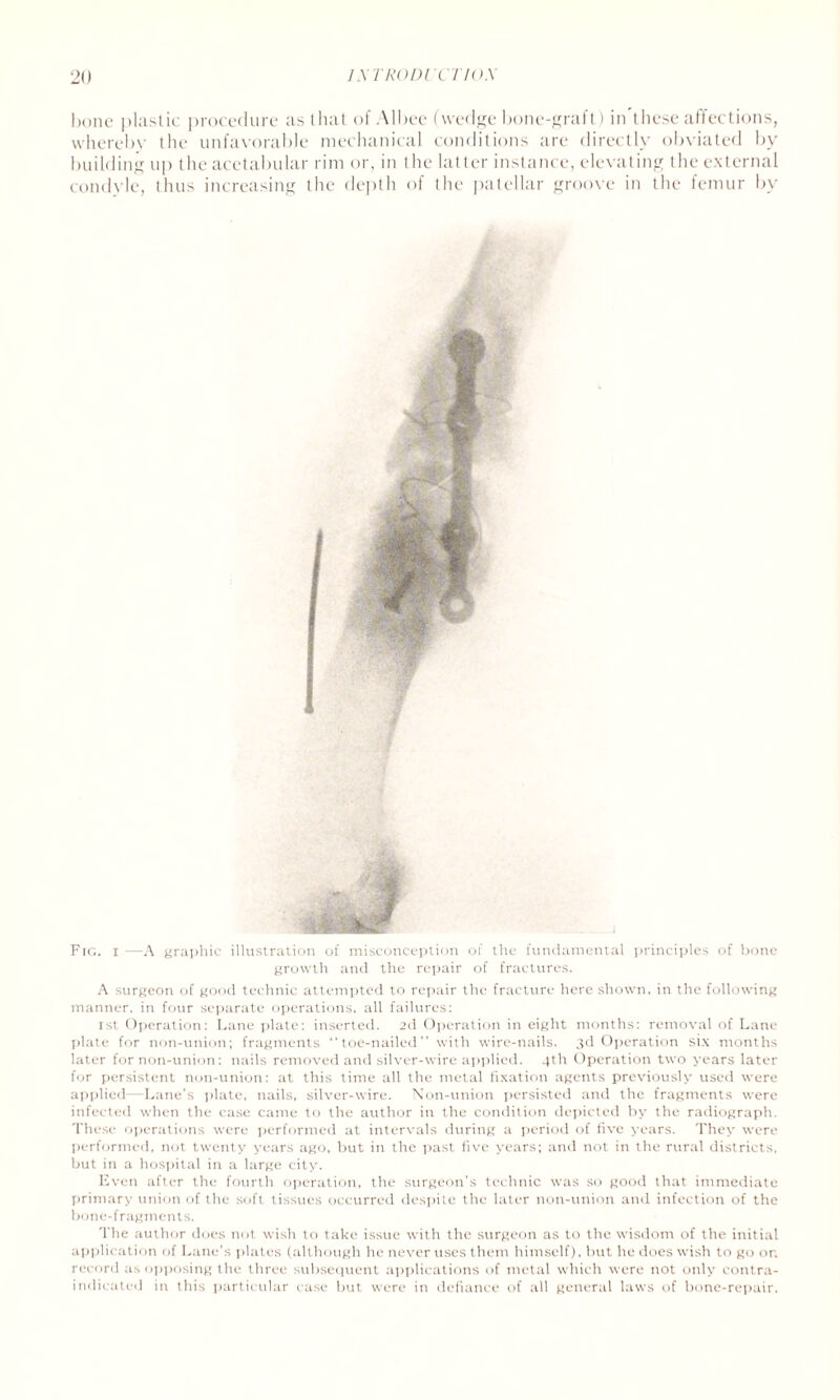 bone plastic procedure as that of Albee (wedge bone-graft) in these affections, whereby the unfavorable mechanical conditions are directly obviated by building up the acetabular rim or, in the latter instance, elevating the external condyle, thus increasing the depth of the patellar groove in the femur by Fig. i—A graphic illustration of misconception of tlie fundamental principles of bone growth and the repair of fractures. A surgeon of good technic attempted to repair the fracture here shown, in the following manner, in four separate operations, all failures: ist Operation: Lane plate: inserted. 2d Operation in eight months: removal of Lane plate for non-union; fragments toe-nailed” with wire-nails. 3d Operation six months later for non-union: nails removed and silver-wire applied. 4th Operation two years later for persistent non-union: at this time all the metal fixation agents previously used were applied—Lane’s plate, nails, silver-wire. Non-union persisted and the fragments were infected when the case came to the author in the condition depicted by the radiograph. These operations were performed at intervals during a period of five years. They were performed, not twenty years ago, but in the past five years; and not in the rural districts, but in a hospital in a large city. Even after the fourth operation, the surgeon’s technic was so good that immediate primary union of the soft tissues occurred despite the later non-union and infection of the bone-fragments. The author does not wish to take issue with the surgeon as to the wisdom of the initial application of Lane's plates (although he never uses them himself), but he does wish to go or. record as opposing the three subsequent applications of metal which were not only contra¬ indicated in this particular case but were in defiance of all general laws of bone-repair.