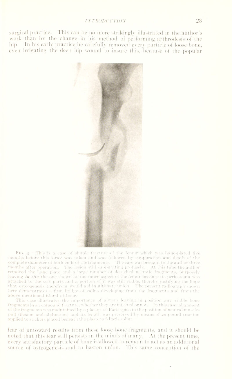 surgical practice. 1 liis can be no more strikingly illustrated in the author's work than by the change in his method ol perlorming arthrodesis o! the hip. In hi-' early practice he carefully removed everv particle of loose bone, even irrigating the deep hip wound to insure this, because of the popular Fig. 3. This is a case of simple fracture of the femur which was Lane-plated five months before this .v-ray was taken and was followed by suppuration and death of the complete diameter of both ends of the fragments. The case was brought to the ant hor three months after operation. The lesion still suppurating profusely. At this time the author removed the Lane plate and a large number of detached necrotic fragments, purposely leaving in silu the one shown at the inner aspect of the femur because its periosteum was attached to the soft parts and a portion of it was still viable, thereby justifying the hope that osteogenesis therefrom would aid in ultimate union. The present radiograph shown here demonstrates a firm bridge of callus developing from the fragments and from the above-mentioned island of bone. This ease illustrates the importance of always leaving in position any viable bone fragments in a compound fract ure. whet her they are infected or not. In this case, alignment of the t rag men t s was maintained by a pluster-of-Paris spica in the position of neutral mtisele- pull (flexion and abduction) and its length was preserved by means of 20 pound traction applied to stickers placed beneath the plasicr-of-Paris splint. fear of untoward results from these loose bone fragments, and it should be noted that this fear still persists in the minds ol many. At the present time, every satisfactorv particle ol bone is allowed to remain toad its tin additional source of osteogenesis and to hasten union. ! his same conception ol the