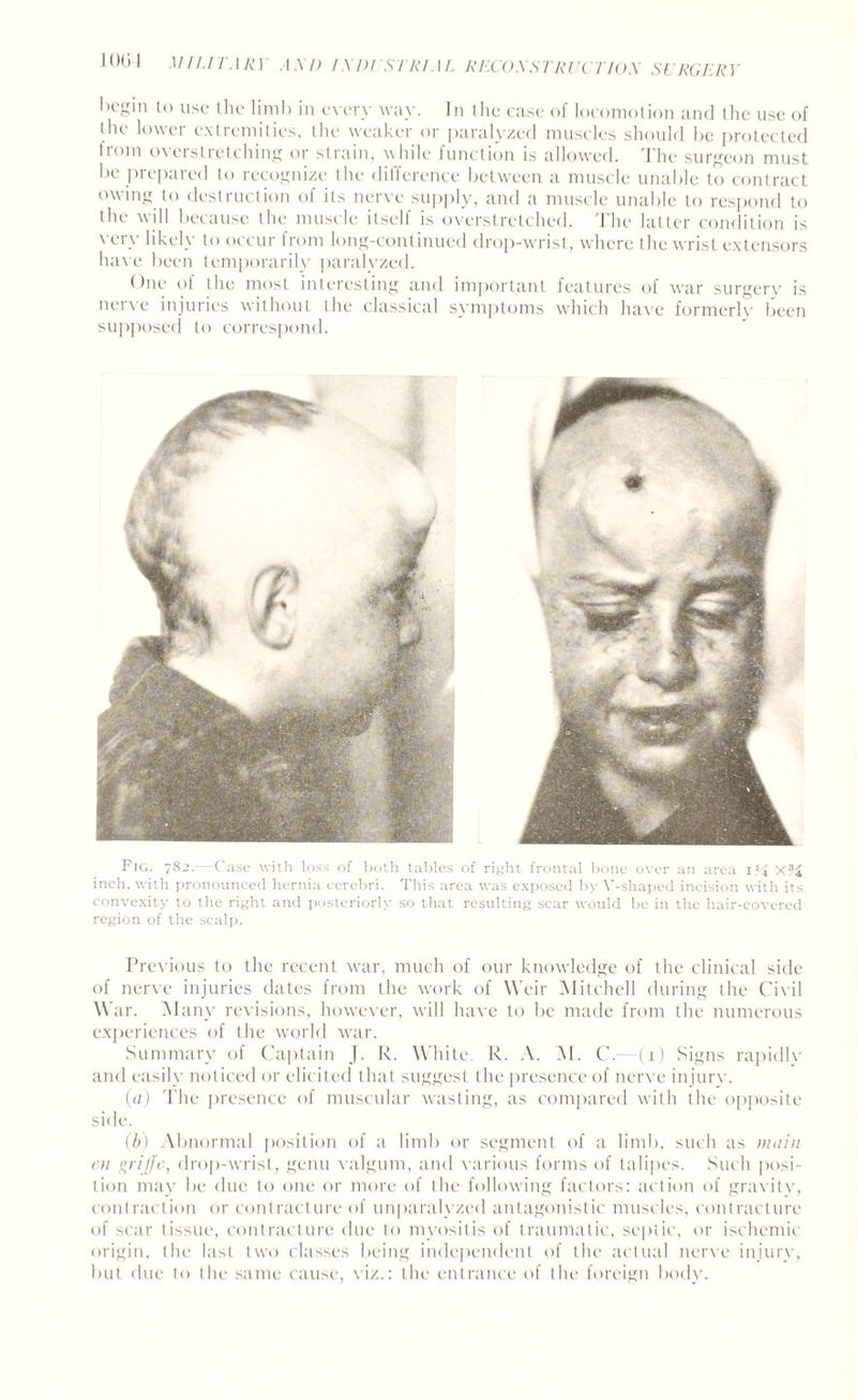 Oegin to use (lie limb in every way. In the case of locomotion and the use of tlie lower extremities, the weaker or paralyzed muscles should be protected from overstretching or strain, while function is allowed. The surgeon must be prepared to recognize the difference between a muscle unable to contract owing to destruction of its nerve supply, and a muscle unable to respond to the will because the muscle itself is overstretched. The latter condition is very likely to occur from long-continued drop-wrist, where the wrist extensors have been temporarily paralyzed. One of the most interesting and important features of war surgery is nerve injuries without the classical symptoms which have formerly been supposed to correspond. Fig. 782.—Case with loss of both tables of right frontal bone over an area i}i X:'£ inch, with pronounced hernia cerebri. This area was exposed by V-shaped incision with its convexity to the right and posteriorly so that resulting scar would be in the hair-covered region of the scalp. Previous to the recent war, much of our knowledge of the clinical side of nerve injuries dates from the work of Weir Mitchell during the Civil War. Many revisions, however, will have to be made from the numerous experiences of the world war. Summary of Captain J. lx. White. R. A. M. C.—(1) Signs rapidly and easily noticed or elicited that suggest the presence of nerve injury. (a) The presence of muscular wasting, as compared with the opposite side. (b) Abnormal position of a limb or segment of a limb, such as main en grifle, drop-wrist, genu valgum, and various forms of talipes. Such posi¬ tion may be due to one or more of the following factors: action of gravity, contraction or contracture of unparalyzed antagonistic muscles, contracture of scar tissue, contracture due to myositis of traumatic, septic, or ischemic origin, the last two classes being independent of the actual nerve injury, but due to the same cause, viz.: the entrance of the foreign body.