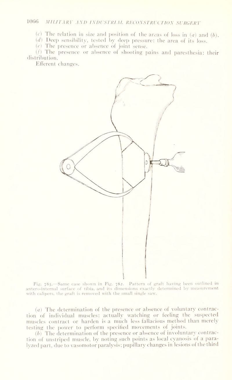 (c) The relation in size and position of the areas of loss in (a) and (b). (</) Dee]) sensibility, tested by deep pressure: the area of its loss. (e) The presence or absence of joint sense. (,/) The presence or absence of shooting pains and paresthesia: their distribution. Efferent changes. Fig. 785.—Same case shown in Fig. 782. Pattern of graft having been outlined in antero-internal surface of tibia, and its dimensions exactly determined by measurement with calipers, the graft is removed with the small single saw. (a) The determination of the presence or absence of voluntary contrac¬ tion of individual muscles: actually watching or feeling the suspected muscles contract or harden is a much less fallacious method than merely testing the power to perform specified movements of joints. (b) The determination of the presence or absence of involuntary contrac¬ tion of unstriped muscle, by noting such points as local cyanosis of a para¬ lyzed part, due to vasomotor paralysis; pupillary changes in lesions of the third