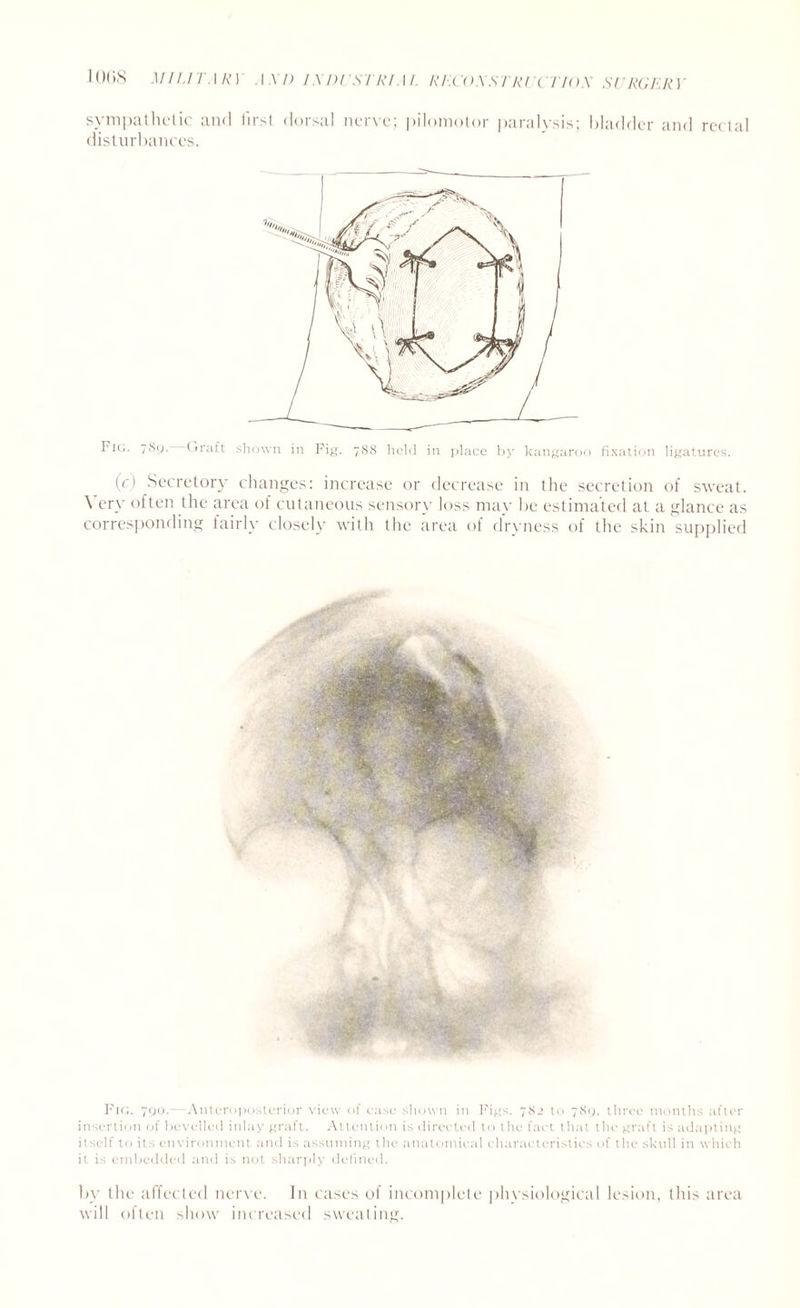 sympathetic and first dorsal nerve; pilomotor paralysis; bladder and rectal disturbances. Pic.. 7S9. (rraft shown in Pig. 788 held in place by kangaroo fixation ligatures. (c) Secretory changes: increase or decrease in the secretion of sweat. \ ery often the area of cutaneous sensory loss may be estimated at a glance as corresponding fairly closely with the area of dryness of the skin supplied Fig. 790.- -Anteroposterior view of case shown in Pigs. 782 to 789, three months after insertion of bevelled inlay graft. Attention is directed to the fact that the graft is adapting itself to its environment and is assuming the anatomical characteristics of the skull in which it is embedded and is not sharply defined. by the affected nerve. In cases of incomplete physiological lesion, this area will often show increased sweating.