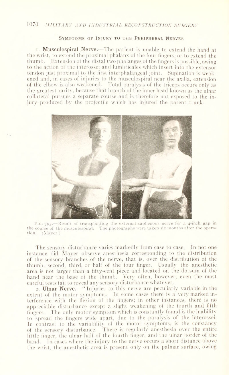 Symptoms of Injury to the Peripheral Nerves i. Musculospiral Nerve. The patient is unable to extend the hand at the wrist, to extend the proximal phalanx of the four fingers, or to extend the thumb. Kxtension of the distal two phalanges of the fingers is possible,owing to the action of the interossei and lumbricales which insert into the extensor tendon just proximal to the first interphalangeal joint. Supination is weak¬ ened and, in cases of injuries to the musculospiral near the axilla, extension of the elbow is also weakened. Total paralysis of the triceps occurs only as the greatest rarity, because that branch of the inner head known as the ulnar collateral pursues a separate course and is therefore not exposed to the in¬ jury produced by the projectile which has injured the parent trunk. Pig. 793.—Result of transplanting the external saphenous nerve for a 4-inch gap in the course of the musculospiral. The photographs were taken six months after the opera¬ tion. (Mayer.) The sensory disturbance varies markedly from case to case. In not one instance did Mayer observe anesthesia corresponding to the distribution of the sensory branches of the nerve, that is, over the distribution of the thumb, second, third, or half of the four finger. Usually the anesthetic area is not larger than a fifty-cent piece and located on the dorsum of the hand near the base of the thumb. Very often, however, even the most careful tests fail to reveal any sensory disturbance whatever. 2. Ulnar Nerve. “ Injuries to this nerve are peculiarly variable in the extent of the motor svmptoms. In some cases there is a very marked in¬ terference with the llexion of the lingers; in other instances, there is no appreciable disturbance except a slight weakening of the fourth and fifth fingers. The only motor symptom which is constantly found is the inability to spread the fingers wide apart, due to the paralysis of the interossei. In contrast to the variability of the motor symptoms, is the constancy of the sensory disturbance. There is regularly anesthesia over the entire little finger, the ulnar half of the fourth finger, and the ulnar border of the hand. In cases where the injury to the nerve occurs a short distance above the wrist, the anesthetic area is present only on the palmar surface, owing