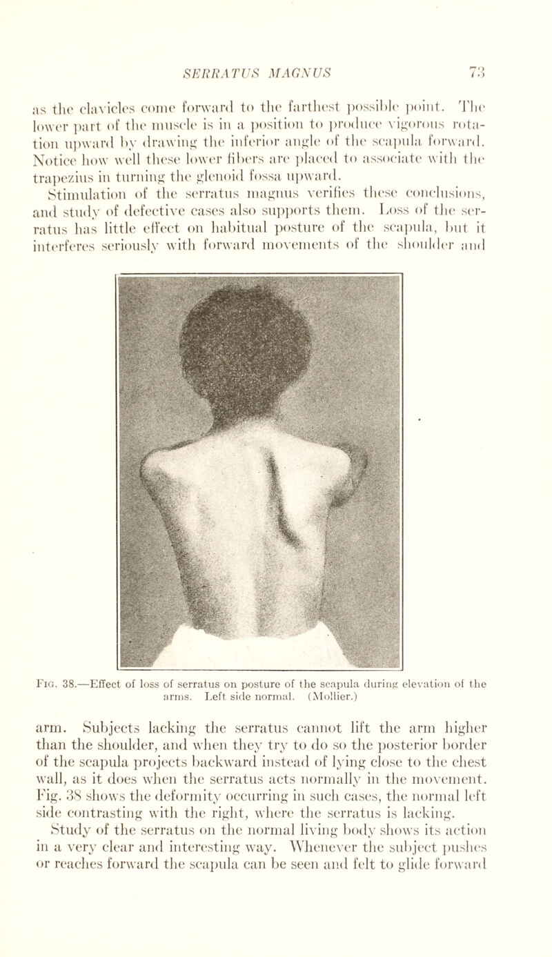 as the clavicles come forward to the farthest ])ossiblc point. The lower part of the muscle is in a position to produce vigorous rota¬ tion upward by drawing the inferior angle of the scapula forward. Notice how well these lower fibers are placed to associate with the trapezius in turning the glenoid fossa upward. Stimulation of the serratus magnus verifies these conclusions, and study of defective cases also supports them. Loss of the ser¬ ratus has little effect on habitual posture of the scapula, but it interferes seriously with forward movements of the shoulder and Fig. 38.—Effect of loss of serratus on posture of the scapula during elevation of the arms. Left side normal. (Mollier.) arm. Subjects lacking the serratus cannot lift the arm higher than the shoulder, and when they try to do so the posterior border of the scapula projects backward instead of lying close to the chest wall, as it does when the serratus acts normally in the movement. Fig. 38 shows the deformity occurring in such cases, the normal left side contrasting with the right, where the serratus is lacking. Study of the serratus on the normal living body shows its action in a very clear and interesting way. Whenever the subject pushes or reaches forward the scapula can be seen and felt to glide forward
