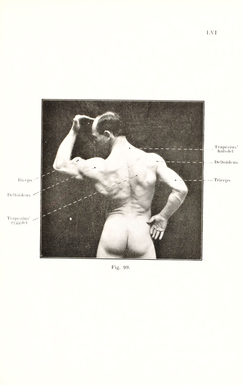 I-VI i; i i • •Ps Dcltoideiis Ti apc/ius' „ ryggdel Irape/ius’ lialsdel Dcltoideiis — Triceps