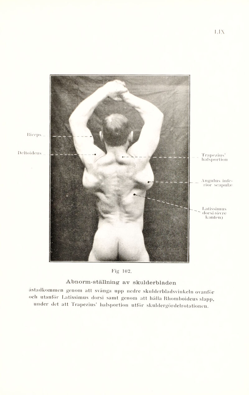 I.l\ I liccps Tmpc/ius’ h.ilsporl ion Angulus ! 11 f < rior scMpul; I .ii lissi m iis dorsi (övre kiinlcii) Fig 102. Abnorm-ställning av skulderbladen åstadkommen genom att svänga upp nedre skulderbladsvinkeln ovanför oeli utanför Latissimus dorsi samt genom att hålla Rliomboideus slapp, under det att I rapezius’ lialsportion utför skuldergördelrotationen.