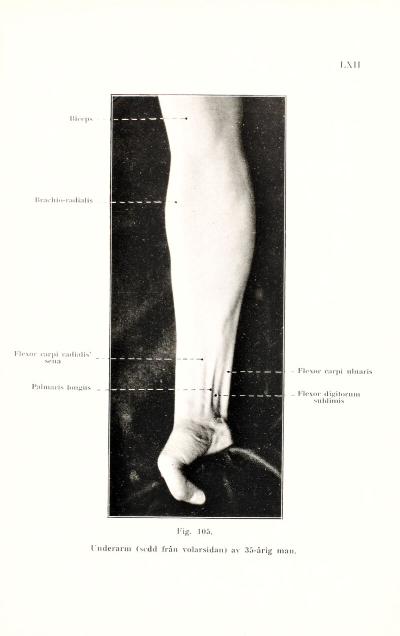 I.XII ISioeps 141 acliio-radialis Flexor rarpi radialis' si>na Palniaris longus - Flexor carpi ulnaris Flexor digilnrum sulilimis Fig. 105. I nderarm (sedd från volarsidan) av 35-årig man.