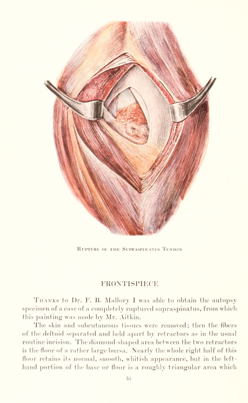 Rupture 01 the Supraspinatus Tendon FRONTISPIECE Thanks to Dr. E. R. M allory I was able to obtain the autopsy specimen of a case of a completely ruptured supraspinatus, from which this painting was made by Mr. Aitkin. 'Pbe skin and subcutaneous tissues were removed; then the fibers of the deltoid separated and held apart by retractors as in the usual routine incision. 'Pbe diamond shaped area between the two retractors is the floor of a rather large bursa. Nearly the whole right half of this floor retains its normal, smooth, whitish appearance, but in the left- hand portion of the base or floor is a roughly triangular area which
