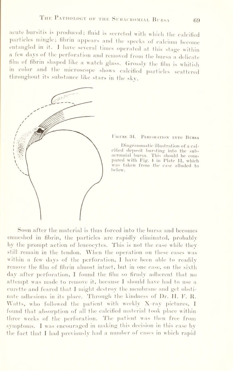 The Pathology OF THE Sr IiACHOM 1AT, Hr Its A (><) aruto bursitis is produced; fluid is secreted with which (lie calcified Particles mingle; fibrin appears and the specks „f calcium become entangled in it. I have several times operated at this stage within a few days of the perforation and removed from the bursa a delicate film of fibrin shaped like a watch glass. Grossly the film is whitish in color and the microscope shows calcified particles scattered throughout its substance like stars in the skv. I'igchi: .'SI. Perforation into Bursa Diagrammatic illustration of a cal¬ cified deposit bursting into the sub¬ acromial Imrsa. This should be com¬ pared with Fig. 4 in Plate II, which was taken from the case alluded to below. Soon after the material is thus forced into the bursa and becomes enmeshed in fibrin, the particles are rapidly eliminated, probably by the prompt action of leucocytes. This is not the case while they still remain in the tendon. When the operation on these cases was within a few days of the perforation, I have been able to readily remove the film of fibrin almost intact, but in one case, on the sixth day after perforation, I found the film so firmly adherent that no attempt was made to remove it, because I should have had to use a curette and feared that I might destroy the membrane and get obsti¬ nate adhesions in its place. Through the kindness o f Dr. II. 1’. It. Watts, who followed the patient with weekly X-ray pictures, I found that absorption of all tbe calcified material took place within three weeks of the perforation. The patient was then free from symptoms. I was encouraged in making this decision in this case by the fact that T had previously had a number of cases in which rapid