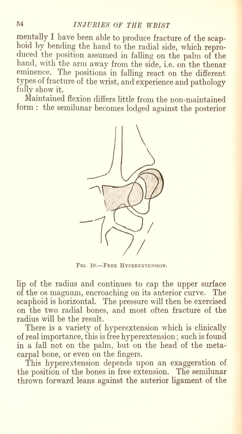 mentally I have been able to produce fracture of the scap¬ hoid by bending the hand to the radial side, which repro¬ duced the position assumed in falling on the palm of the hand, with the arm away from the side, i.e. on the thenar eminence. The positions in falling react on the different types of fracture of the wrist, and experience and pathology fully show it. Maintained flexion differs little from the non-maintained form : the semilunar becomes lodged against the posterior Fig. 10.—Free Hyperextension. lip of the radius and continues to cap the upper surface of the os magnum, encroaching on its anterior curve. The scaphoid is horizontal. The pressure will then be exercised on the two radial bones, and most often fracture of the radius will be the result. There is a variety of hyperextension which is clinically of real importance, this is free hyperextension; such is found in a fall not on the palm, but on the head of the meta¬ carpal bone, or even on the fingers. This hyperextension depends upon an exaggeration of the position of the bones in free extension. The semilunar thrown forward leans against the anterior ligament of the