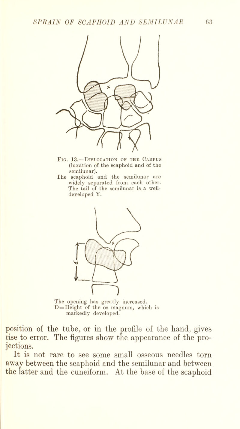 Fig. 13.—Dislocation of the Carpus (luxation of the scaphoid and of the semilunar). The scaphoid and the semilunar are widely separated from each other. The tail of the semilunar is a well- developed Y. (-) The opening has greatly increased. D = Height of the os magnum, which is markedly developed. position of the tube, or in the profile of the hand, gives rise to error. The figures show the appearance of the pro¬ jections. It is not rare to see some small osseous needles torn away between the scaphoid and the semilunar and between the latter and the cuneiform. At the base of the scaphoid