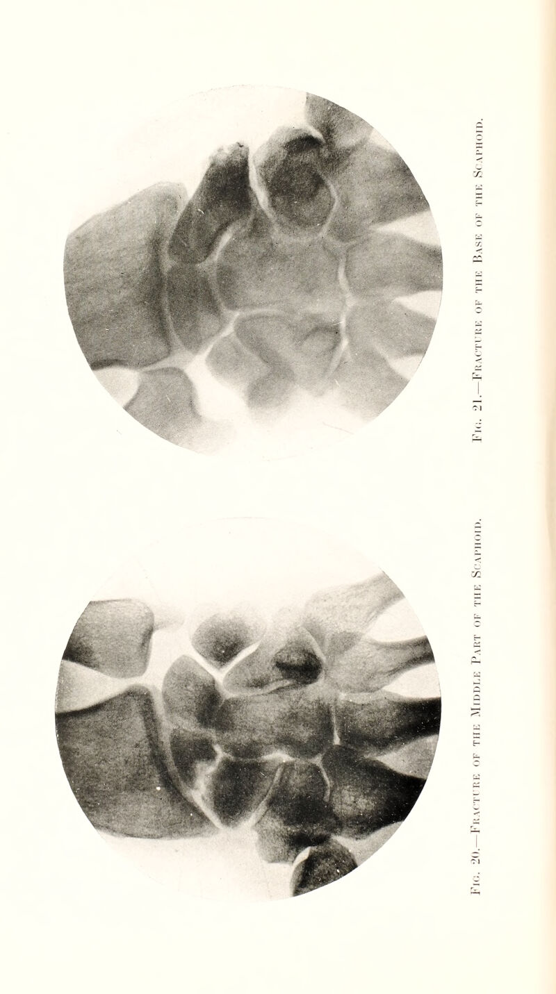 {ACT('RE OF TUI1; MIDDLE PART OF THE SCAPIIOTP. Fid. 21.— FrACTI'RE OF THE RaSE OF THE SCAPHOID.