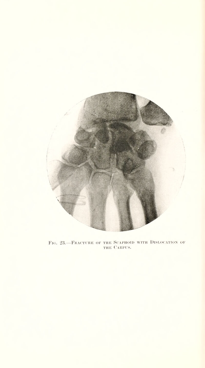 I I Fin. 23.—Fracture of the Scaphoid with Dislocation of THE ('AKPl’S.