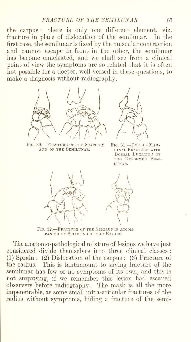 the carpus: there is only one different element, viz. fracture in place of dislocation of the semilunar. In the first case, the semilunar is fixed by the muscular contraction and cannot escape in front in the other, the semilunar has become enucleated, and we shall see from a clinical point of view the symptoms are so related that it is often not possible for a doctor, well versed in these questions, to make a diagnosis without radiography. Fig. 30.—Fracture of the Scaphoid AND OF THE SEMILUNAR. Fig. 31.—Double Mar¬ ginal Fracture with Dorsal Luxation of the Deformed Semi¬ lunar. Fig. 32.—Fracture of the Semilunar accom¬ panied ba' Splitting of the Radius. The anatomo-pathological mixture of lesions we have just considered divide themselves into three clinical classes : (1) Sprain : (2) Dislocation of the carpus : (3) Fracture of the radius. This is tantamount to saying fracture of the semilunar has few or no symptoms of its own, and this is not surprising, if we remember this lesion had escaped observers before radiography. The mask is all the more impenetrable, as some small intra-articular fractures of the radius without symptoms, hiding a fracture of the semi-