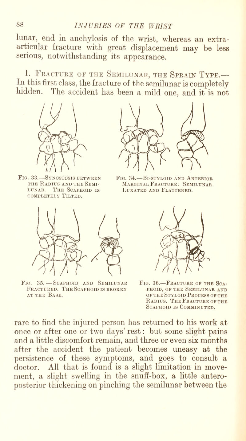 lunar, end in anchylosis of the wrist, whereas an extra- articular fracture with great displacement may be less serious, notwithstanding its appearance. I. Fracture of the Semilunar, the Sprain Type.— In this first class, the fracture of the semilunar is completely hidden. The accident has been a mild one, and it is not Fig. 33.—Synostosis between the Radius and the Semi¬ lunar. The Scaphoid is COMPLETELY' TlLTED. Fig. 34.—Bi-styloid and Anterior Marginal Fracture : Semilunar Luxated and Flattened. Fig. 35. — Scaphoid and Semilunar Fractured. The Scaphoid is broken at the Base. Fig. 36.—Fracture of the Sca¬ phoid, of the Semilunar and of the Styloid Process of the Radius. The Fracture of the Scaphoid is Comminuted. rare to find the injured person has returned to his work at once or after one or two days’ rest: but some slight pains and a little discomfort remain, and three or even six months after the accident the patient becomes uneasy at the persistence of these symptoms, and goes to consult a doctor. All that is found is a slight limitation in move¬ ment, a slight swelling in the snuff-box, a little antero¬ posterior thickening on pinching the semilunar between the