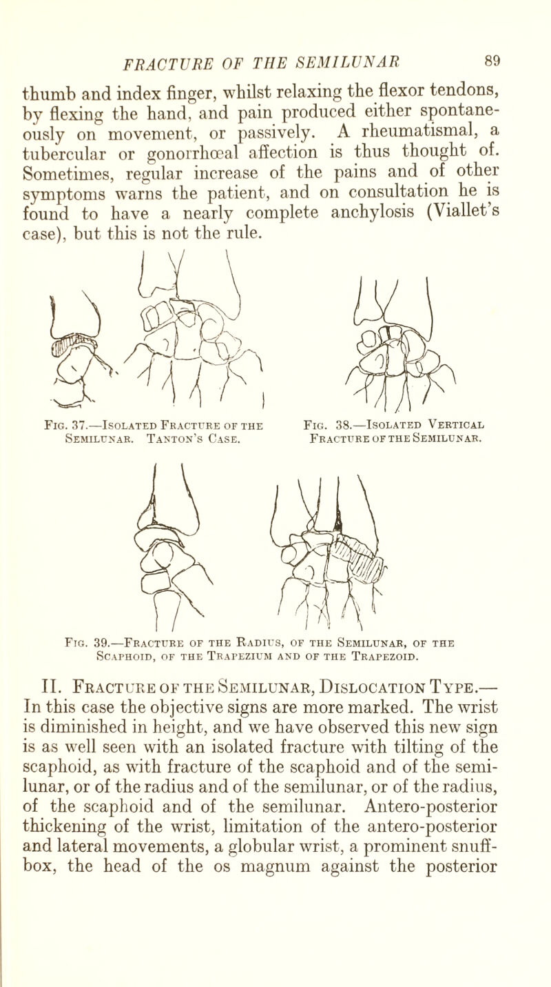 thumb and index finger, whilst relaxing the flexor tendons, by flexing the hand, and pain produced either spontane¬ ously on movement, or passively. A rheumatismal, a tubercular or gonorrhoeal affection is thus thought of. Sometimes, regular increase of the pains and of other symptoms warns the patient, and on consultation he is found to have a nearly complete anchylosis (Viallet s case), but this is not the rule. Fig. 37.—Isolated Fracture of the Semilunar. Tanton’s Case. Fig. 38.—Isolated Vertical Fracture of the Semilunar. Fig. 39.—Fracture of the Radius, of the Semilunar, of the Scaphoid, of the Trapezium and of the Trapezoid. II. Fracture of the Semilunar, Dislocation Type.— In this case the objective signs are more marked. The wrist is diminished in height, and we have observed this new sign is as well seen with an isolated fracture with tilting of the scaphoid, as with fracture of the scaphoid and of the semi¬ lunar, or of the radius and of the semilunar, or of the radius, of the scaphoid and of the semilunar. Antero-posterior thickening of the wrist, limitation of the antero-posterior and lateral movements, a globular wrist, a prominent snuff¬ box, the head of the os magnum against the posterior