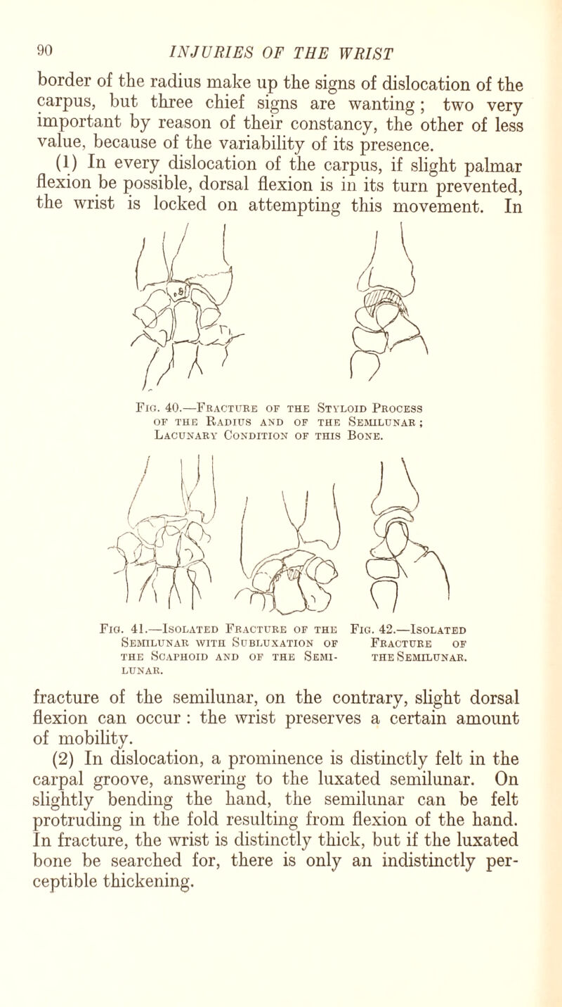 border of the radius make up the signs of dislocation of the carpus, but three chief signs are wanting; two very important by reason of their constancy, the other of less value, because of the variability of its presence, (1) In every dislocation of the carpus, if slight palmar flexion be possible, dorsal flexion is in its turn prevented, the wrist is locked on attempting this movement. In Fig. 40.—Fracture of the Styloid Process of the Radius and of the Semilunar ; Lacunary Condition of this Bone. Fig. 41.—Isolated Fracture of the Fig. 42.—Isolated Semilunar with Subluxation of Fracture of the Scaphoid and of the Semi- the Semilunar, lunar. fracture of the semilunar, on the contrary, slight dorsal flexion can occur : the wrist preserves a certain amount of mobility. (2) In dislocation, a prominence is distinctly felt in the carpal groove, answering to the luxated semilunar. On slightly bending the hand, the semilunar can be felt protruding in the fold resulting from flexion of the hand. In fracture, the wrist is distinctly thick, but if the luxated bone be searched for, there is only an indistinctly per¬ ceptible thickening.