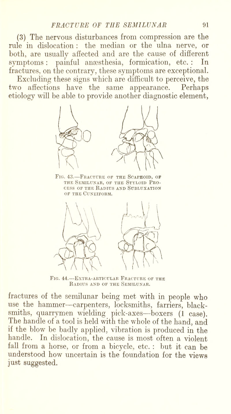 (3) The nervous disturbances from compression are the rule in dislocation : the median or the ulna nerve, or both, are usually affected and are the cause of different symptoms: painful anaesthesia, formication, etc. : In fractures, on the contrary, these symptoms are exceptional. Excluding these signs which are difficult to perceive, the two affections have the same appearance. Perhaps etiology will be able to provide another diagnostic element, 0 Fig. 43.—Fracture of the Scaphoid, of the Semilunar, of the Styloid Pro¬ cess of the Radius and Subluxation of the Cuneiform. Fig. 44.—Extra-articular Fracture of the Radius and of the Semilunar. fractures of the semilunar being met with in people who use the hammer—carpenters, locksmiths, farriers, black¬ smiths, quarrymen wielding pick-axes—boxers (1 case). The handle of a tool is held with the whole of the hand, and if the blow be badly applied, vibration is produced in the handle. In dislocation, the cause is most often a violent fall from a horse, or from a bicycle, etc. : but it can be understood how uncertain is the foundation for the views just suggested.