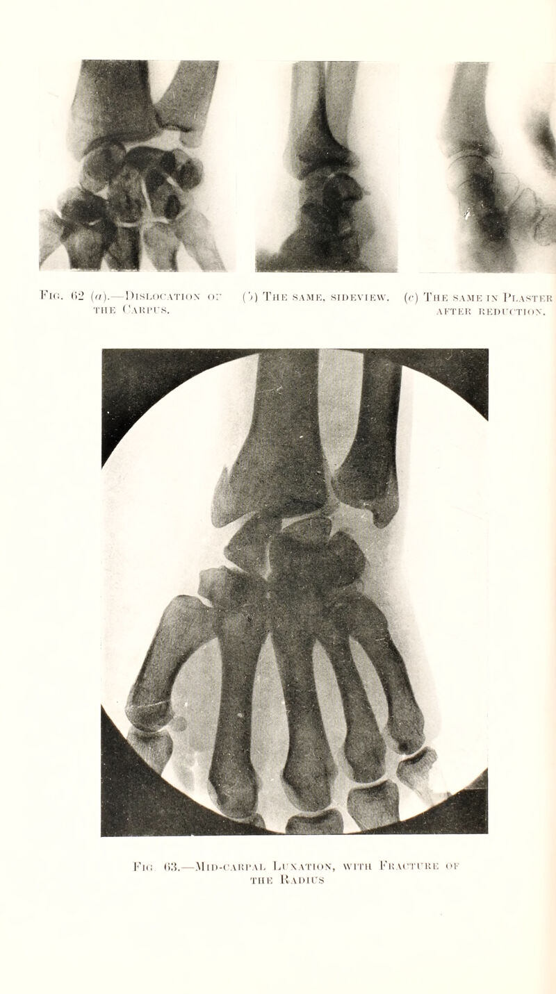 Fig. l>2 (a).—Dislocation or THE CaHPI'S. (’;) The same, sideview. (<•) The same in Plaster AFTER REDUCTION. |<i<; Mid-carpal Fi xation, with Fracture of the Radius