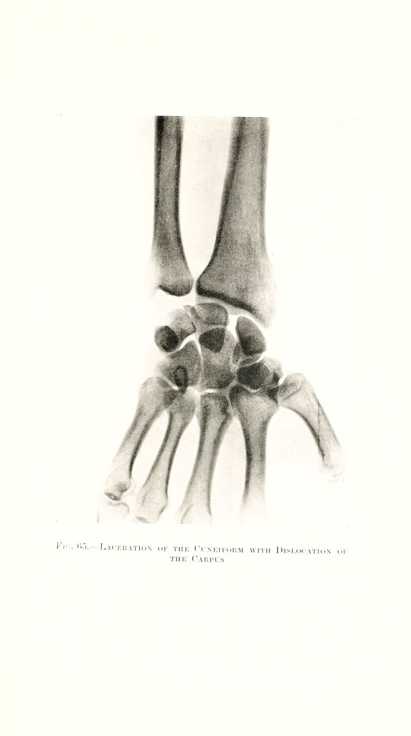 11 ■ l1’’- I-ackkation of the Ci \kifokm wrm Dislocation of T1IE ( 'AHI’US