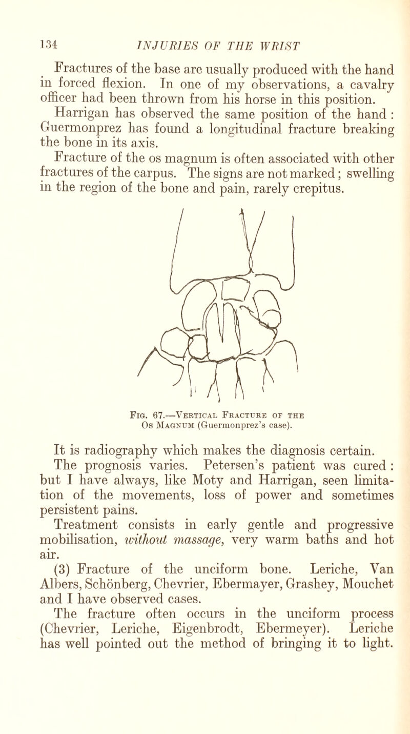 Fractures of the base are usually produced with the hand in forced flexion. In one of my observations, a cavalry officer had been thrown from his horse in this position. Harrigan has observed the same position of the hand : Guermonprez has found a longitudinal fracture breaking the bone in its axis. Fracture of the os magnum is often associated with other fractures of the carpus. The signs are not marked; swelling in the region of the bone and pain, rarely crepitus. Fig. 67.—Vertical Fracture of the Os Magnum (Guermonprez’s case). It is radiography which makes the diagnosis certain. The prognosis varies. Petersen’s patient was cured : but I have always, like Moty and Harrigan, seen limita¬ tion of the movements, loss of power and sometimes persistent pains. Treatment consists in early gentle and progressive mobilisation, without massage, very warm baths and hot air. (3) Fracture of the unciform bone. Leriche, Van Albers, Schonberg, Chevrier, Ebermayer, Grashey, Mouchet and I have observed cases. The fracture often occurs in the unciform process (Chevrier, Leriche, Eigenbrodt, Ebermeyer). Leriche has well pointed out the method of bringing it to light.