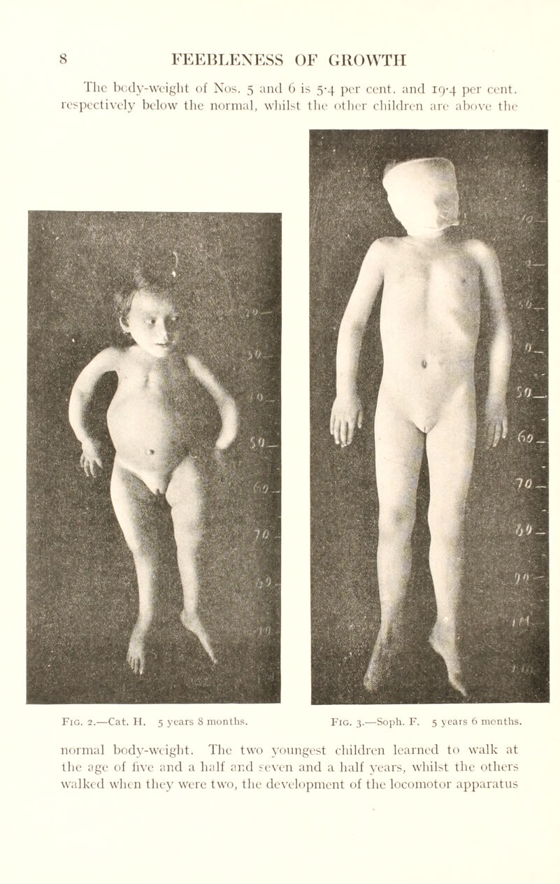 1 lie body-weight of Nos. 5 and 6 is 5^4 per cent, and 19-4 per cent, respectively below the normal, whilst the other children are above the Fig. 2.—Cat. H. 5 years 8 months. Fig. 3.—Soph. F. 5 years 6 months. normal body-weight. The two youngest children learned to walk at the age of live and a half and seven and a half years, whilst the others walked when they were two, the development of the locomotor apparatus