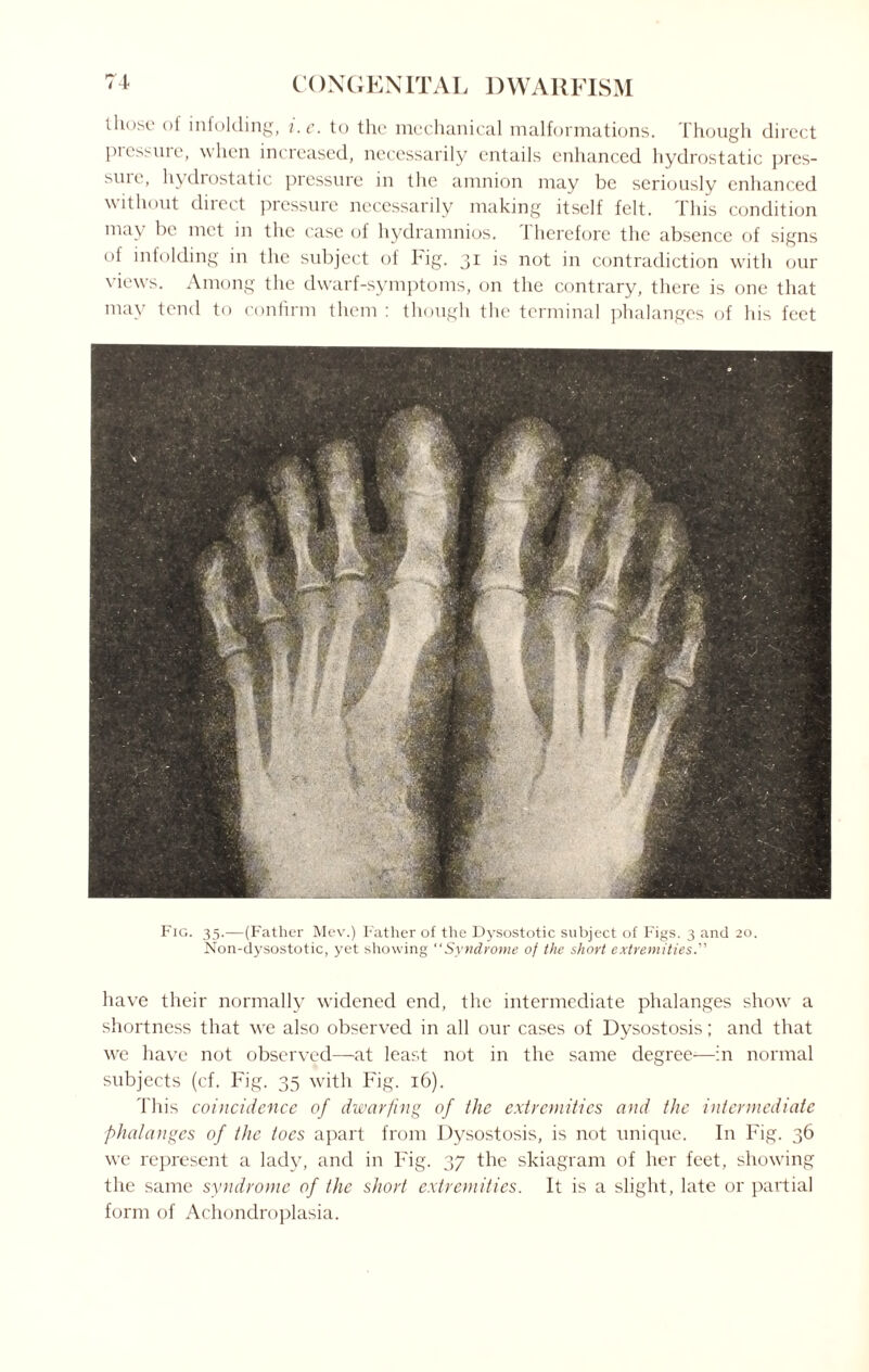 those of infolding, i.c. to the mechanical malformations. Though direct pressure, when increased, necessarily entails enhanced hydrostatic pres¬ sure, hydrostatic pressure in tlie amnion may be seriously enhanced without direct pressure necessarily making itself felt. This condition may be met in the case of hydramnios. 1 herefore the absence of signs of infolding in the subject of Fig. 31 is not in contradiction with our views. Among the dwarf-symptoms, on the contrary, there is one that may tend to confirm them : though the terminal phalanges of his feet Fig. 35.—(Father Mev.) Father of the Dysostotic subject of Figs. 3 and 20. Non-dysostotic, yet showing “Syndrome of the short extremities.” have their normally widened end, the intermediate phalanges show a shortness that we also observed in all our cases of Dysostosis; and that we have not observed—at least not in the same degree-—in normal subjects (cf. Fig. 35 with Fig. 16). This coincidence of dwarfing of the extremities and the intermediate phalanges of the toes apart from Dysostosis, is not unique. In Fig. 36 we represent a lady, and in Fig. 37 the skiagram of her feet, showing the same syndrome of the short extremities. It is a slight, late or partial form of Achondroplasia.
