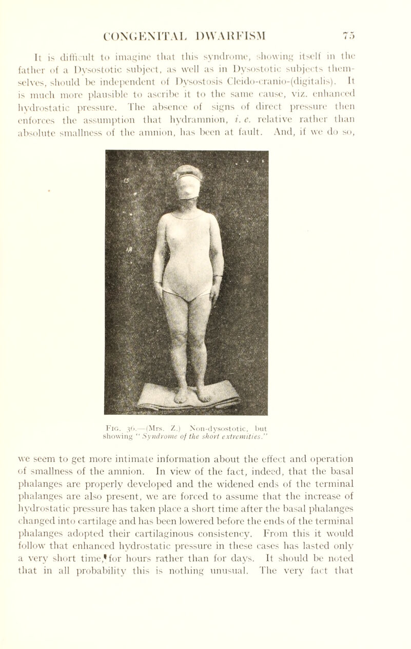 It is difficult to imagine that this syndrome, showing itself in the father of a Dysostotic subject, as well as in Dysostotic subjects them¬ selves, should be independent of Dysostosis Cleido-cranio-(digitalis). It i> much more plausible to ascribe it to the same cause, viz. enhanced hydrostatic pressure. Ihe absence of signs of direct pressure then enforces the assumption that hydramnion, i. c. relative rather than absolute smallness of the amnion, has been at fault. And, if we do so, Fig. 36.—(Mrs. Non-dysostotic, but showing “ Syndrome of the short extremities.” we seem to get more intimate information about the effect and operation of smallness of the amnion. In view of the fact, indeed, that the basal phalanges are properly developed and the widened ends of the terminal phalanges are also present, we are forced to assume that the increase of hydrostatic pressure has taken place a short time after the basal phalanges changed into cartilage and has been lowered before the ends of the terminal phalanges adopted their cartilaginous consistency. From this it 'would follow that enhanced hydrostatic pressure in these cases has lasted only a very short time,'for hours rather than for days. It should be noted that in all probability this is nothing unusual. The very fact that