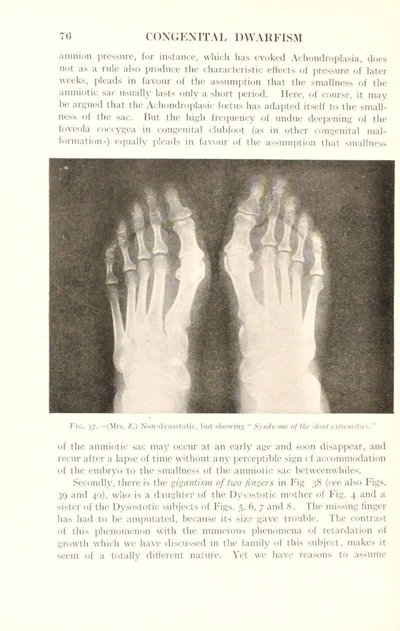 amnion pressure, for instance, which has evoked Achondroplasia, does not as a rule also produce the characteristic effects of pressure of later weeks, pleads in favour of the assumption that the smallness of the amniotic sac usually lasts only a short period. Here, of course, it may be argued that the Achondroplasic feetus has adapted itself to the small¬ ness of the sac. But the high frequency of undue deepening of the foveola coccygea in congenital clubfoot (as in other congenital mal¬ formation-) equally pleads in favour of the assumption that smallness Fig. 37.—(Mrs. Z.) Non-dysostotic, but showing “ Syndrome of the short extremities.'' of the amniotic sac may occur at an early age and soon disappear, and recur after a lapse of time without any perceptible sign cf accommodation of the embryo to the smallness of the amniotic sac betweenwhiles. Secondly, there is the gigantism of two fingers in Fig 38 (see also Figs. 39 and 40), who is a daughter of the Dysostotic mother of Fig. 4 and a sister of the Dysostotic subjects of Figs. 5, 6, 7 and 8. The missing finger has had to be amputated, because its size gave trouble. The contrast of this phenomenon with the numerous phenomena of retardation of growth which we have discussed in the family of this subject, makes it seem of a totally different nature. Yet we have reasons to assume