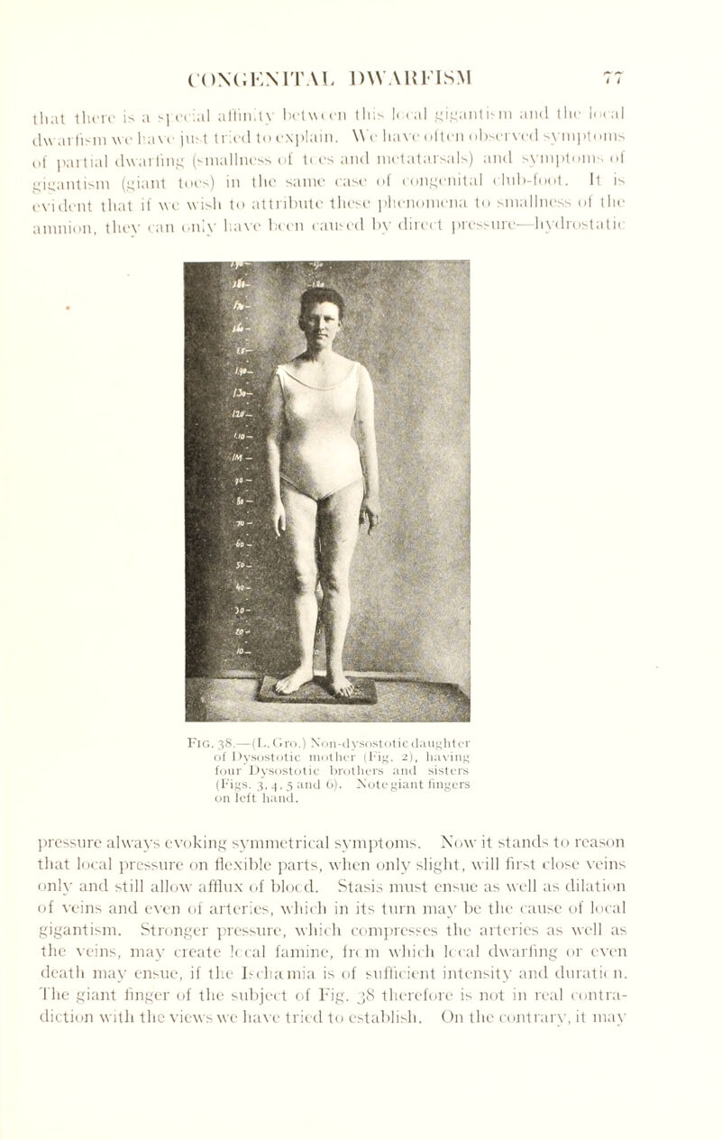 that there is a fecial affinity between this I* cal gigantism and the local dw arfism we haw pet tried to explain. W e have olten observed syinjdoms of partial dwarfing (smallness of t< es and metatarsals) and symptoms of gigantism (giant toes) in the same case of congenital chib-foot. It is evident that if we wish to attribute these phenomena to smallness of the amnion, they can only have been caused by diiect picssuie hydrostatic Fig. 38.—(L. Gro.) Non-dysostotic daughter of Dysostotic mother (Fig. 2), having four Dysostotic brothers and sisters (Figs. 3, j , 5 and 6). Note giant lingers on left hand. pressure always evoking symmetrical symptoms. Now it stands to reason that local pressure on flexible parts, when only slight, will first close veins only and still allow afflux of blocd. Stasis must ensue as well as dilation of veins and even of arteries, which in its turn may be the cause of local gigantism. Stronger pressure, which compresses the arteries as well as the veins, may create k cal famine, fre m which local dwarfing or even death may ensue, if the Ischamia is of sufficient intensity and duratk n. The giant linger of the subject of Fig. 38 therefore is not in real contra¬ diction with the views we have tried to establish. On the contrary, it may