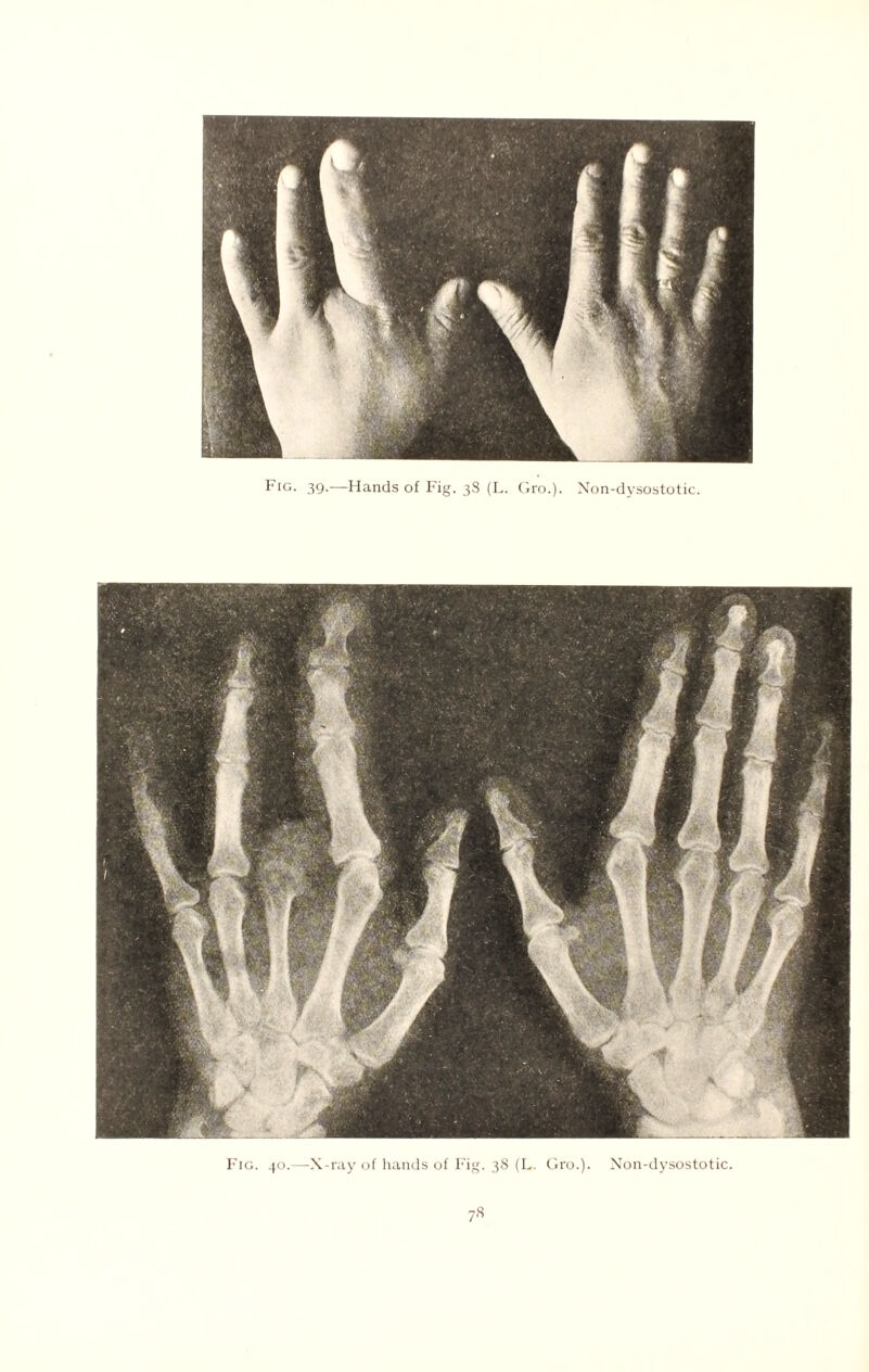 Fig. 39.—Hands of Fig. 3S (L. Gro.). Non-dysostotic. Fig. 40.—X-ray of hands of Fig. 38 (L. Gro.). Non-dysostotic.