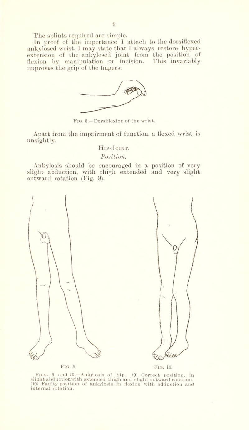 The splints required are simple. In proof of the importance T attach to the dorsiflexed ankylosed wrist, I may state that l always restore hyper¬ extension of the ankylosed joint from the position of flexion by manipulation or incision. This invariably improves the grip of the fingers. Fig. 8.—Dorsiflexion of the wrist. Apart from the impairment of function, a flexed wrist is unsightly. Hip-Joint. Position. Ankylosis should be encouraged in a position of very slight abduction, with thigh extended and very slight outward rotation (Fig. 9). Fig. 9. Fio. 10. Figs. 9 and 10.—Ankylosis of hip. (9) Correct position, in slight abductionwith extended thigh and slight outward rotation. (10) Faulty position of ankylosis in flexion with adduction and internal rotation.