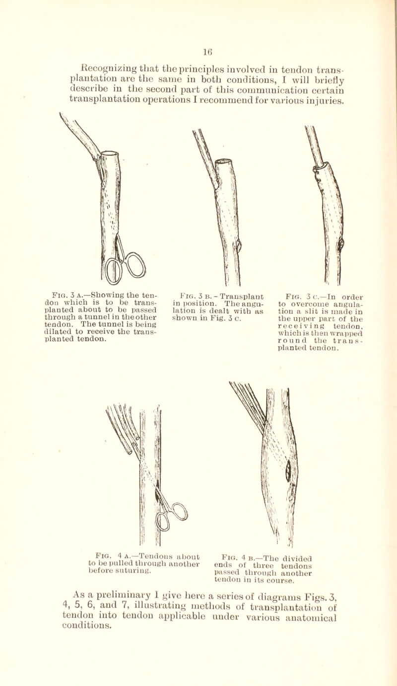 Recognizing that the principles involved in tendon trans¬ plantation are the same in both conditions, I will briefly describe in the second part of this communication certain transplantation operations I recommend for various injuries. Pig. 3 a.—Showing the ten¬ don which is to be trans¬ planted about to be passed through a tunnel in the other tendon. The tunnel is being dilated to receive the trans¬ planted tendon. Fig. 3 b.- Transplant in position. The angu¬ lation is dealt with as shown in Fig. 3 c. Fig. 3 c.—In order to overcome angula¬ tion a slit is made in the upper part of the receiving tendon, which is then wrapped round the trans¬ planted tendon. Fig. 4 a.—Tendons about to be pulled through another before suturing. Fig. 4 i).—The divided ends of three tendons passed through another tendon in its course. As a preliminary 1 give here a series of diagrams Figs. 3, 4, 5, 6, and 7, illustrating methods of transplantation of tendon into tendon applicable under various anatomical conditions.