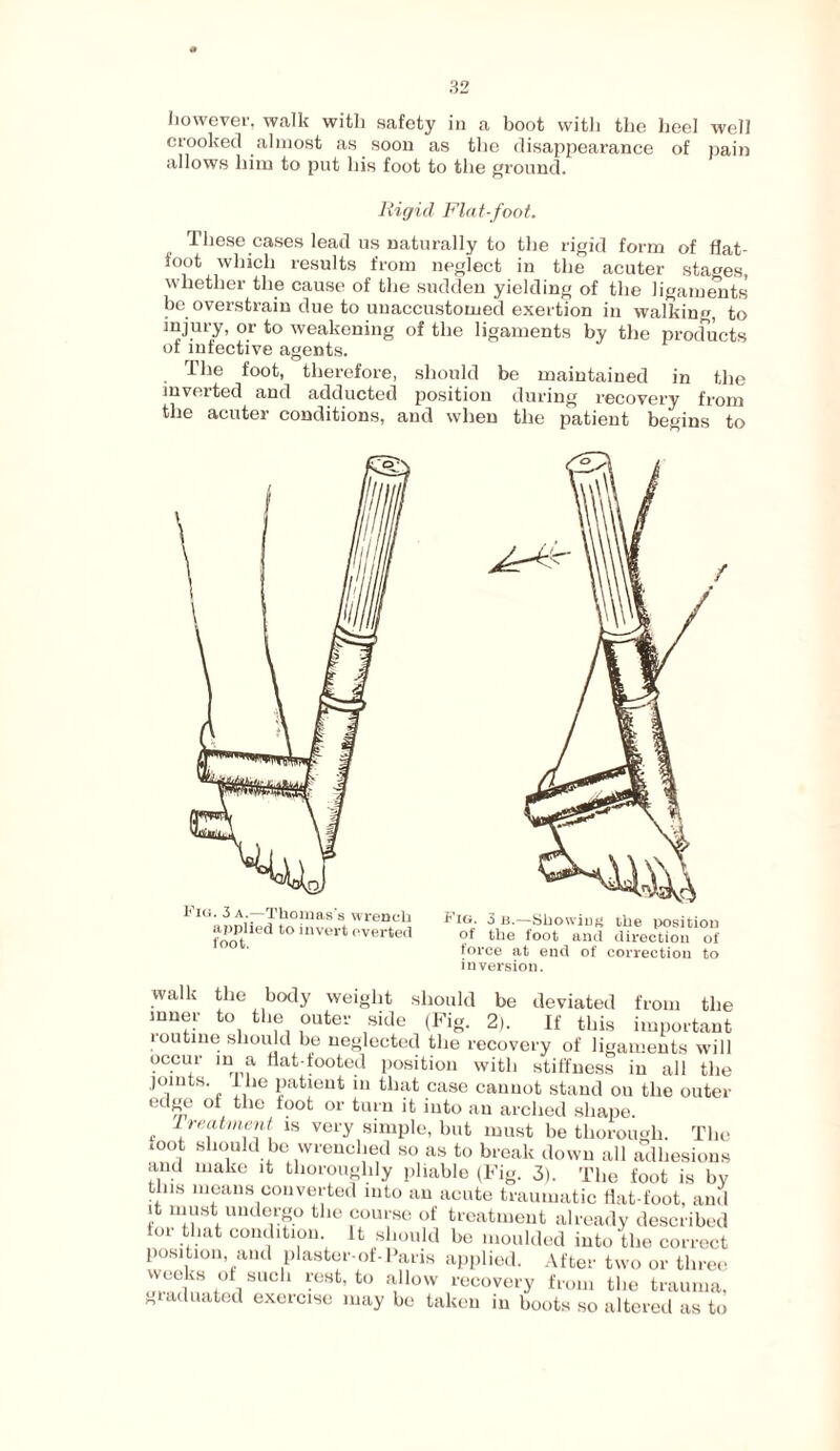 however, walk with safety in a boot witli the heel well crooked almost as soon as the disappearance of pain allows him to put his foot to the ground. Rigid Flat-foot. These cases lead us naturally to the rigid form of flat- foot which results from neglect in the acuter stages, whether the cause of the sudden yielding of the ligaments be overstrain due to unaccustomed exertion in walking, to injury, or to weakening of the ligaments by the products of infective agents. the foot, therefore, should be maintained in the inverted and adducted position during recovery from the acuter conditions, and when the patient begins to frio. 3b.—Sbowiug the position of the foot and direction of force at end of correction to inversion. walk the body weight should be deviated from the inner to the outer side (Pig. 2). If this important loutine should be neglected the recovery of ligaments will occur in a flat-footed position with stiffness in all the joints. 1 lie patient in that case cannot stand ou the outer edge of the foot or turn it into an arched shape. Treatment is very simple, but must be thorough. The toot should be wrenched so as to break down all adhesions and make it thoroughly pliable (Fig. 3). The foot is by this means converted into an acute traumatic Hat-foot, and it must undergo the course of treatment already described tor that condition It should be moulded into the correct position, and plaster-of-Paris applied. After two or three weeks of such rest, to allow recovery from the trauma, graduated exercise may be taken in boots so altered as to