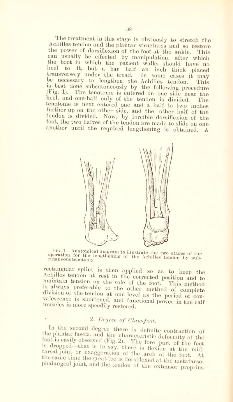 The treatment in this stage is obviously to stretch the Achilles tendon and the plantar structures and so restore the power of dorsiflexion of the foot at the ankle. This can usually be effected by manipulation, after which the boot in which the patient walks should have no heel to it, but a bar half an inch thick placed transversely under the tread. In some cases it may be necessary to lengthen the Achilles tendon. This is best done subcutaneously by the following procedure (Fig. 1). The tenotome is entered on one side near the heel, and one-half only of the tendon is divided. The tenotome is next entered one and a half to two inches further up on the other side, and the other half of the tendon is divided. Now, by forcible dorsiflexion of the foot, the two halves of the tendon are made to slide on one another until the required lengthening is obtained. A h Anatomical diagram to illustrate the two stages of the SS ££,££« u* ACM,™ taSSSV^a; A S8 lar ?plmt, 1S tllC11 applied so as to keep the . clnlles tendon at rest in the corrected position and to maintain tension on the sole of the foot. This method is always preferable to the other method of complete division of the tendon at one level as the period of‘con¬ valescence is shortened, and functional power in the calf muscles is more speedily restored. * 2. Degree of Claw-foot. In the second degree there is definite contraction of the plantar fascia, and the characteristic deformity of the TI'«? f01'* Part of the foot is dropped that is to say, there is flexion at the mid- tarsal joint or exaggeration of the arch of the foot At the same time the great too is dorsiflexed at the metatarso¬ phalangeal joint, and the tendon of the extensor proprius