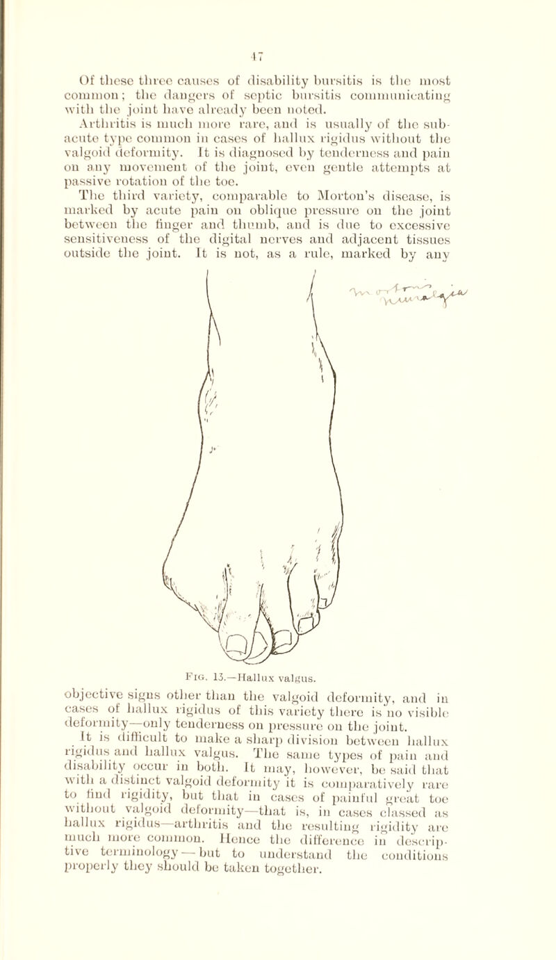 IT Of these three causes of disability bursitis is the most common; the dangers of septic bursitis communicating with the joint have already been noted. Arthritis is much more rare, and is usually of the sub¬ acute type common in cases of hallux rigidus without the valgoid deformity. It is diagnosed by tenderness and pain on any movement of the joint, even gentle attempts at passive rotation of the toe. The third variety, comparable to Morton’s disease, is marked by acute pain on oblique pressure on the joint between the finger and thumb, and is due to excessive sensitiveness of the digital nerves and adjacent tissues outside the joint. It is not, as a rule, marked by any Fig. 13.—Hallux valgus. objective signs other than the valgoid deformity, and in cases of hallux rigidus of this variety there is no visible deformity -only tenderness on pressure on the joint. It is difficult to make a sharp division between hallux rigidus and hallux valgus. The same types of pain and disability occur in both. It may, however, be said that with a distinct valgoid deformity it is comparatively rare to lind rigidity, but that in cases of painful great toe without valgoid deformity—that is, in cases classed as hallux rigidus arthritis and the resulting rigidity are much more common. Hence the difference in descrip¬ tive terminology—but to understand the conditions properly they should be taken together.