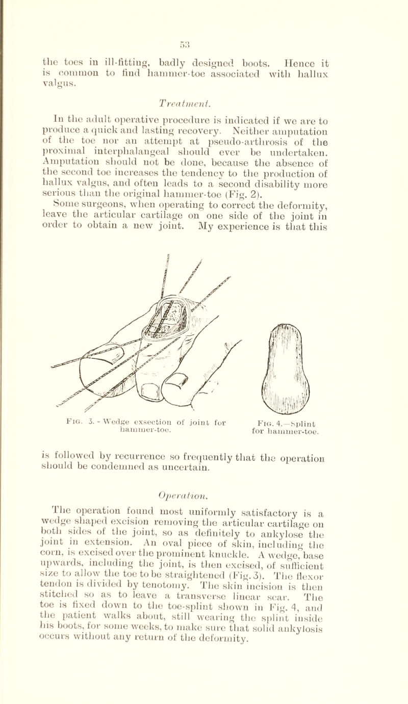 the toes in ill-fitting, badly designed boots. Ilcnce it is common to find hammer-toe associated with hallux valgus. Treatment. In the adult operative procedure is indicated if we are to produce a quick and lasting recovery. Neither amputation of the toe nor an attempt at pseudo-arthrosis of the proximal interplialangeal should ever be undertaken. Amputation should not be done, because the absence of the second toe increases the tendency to the production of hallux valgus, and often leads to a second disability more serious than the original hammer-toe (Fig. 2). Some surgeons, when operating to correct the deformity, leave the articular cartilage on one side of the joint in order to obtain a new joint. My experience is that this Fig. 3.-Wedge exsection of joint for hammer-toe. Fig. 4.—Splint for hammer-toe. is followed by recurrence so frequently that the operation should be condemned as uncertain. Operation. The operation found most uniformly satisfactory is a wedge shaped excision removing the articular cartilage on both sides of the joint, so as definitely to ankylose the joint in extension. An oval piece of skin, including the corn, is excised over the prominent knuckle. A wedgefbase upwaids, including the joint, is then excised, of sufficient size to allow the toe to be straightened (Fig. 3). The flexor tendon is divided by tenotomy. The skin incision is then stitched so as to leave a transverse linear scar. The toe is fixed down to the toe-splint shown in Fig. 4, and the patient walks about, still wearing the splint inside his boots, for some weeks, to make sure that solid ankylosis occurs without any return of the deformity.