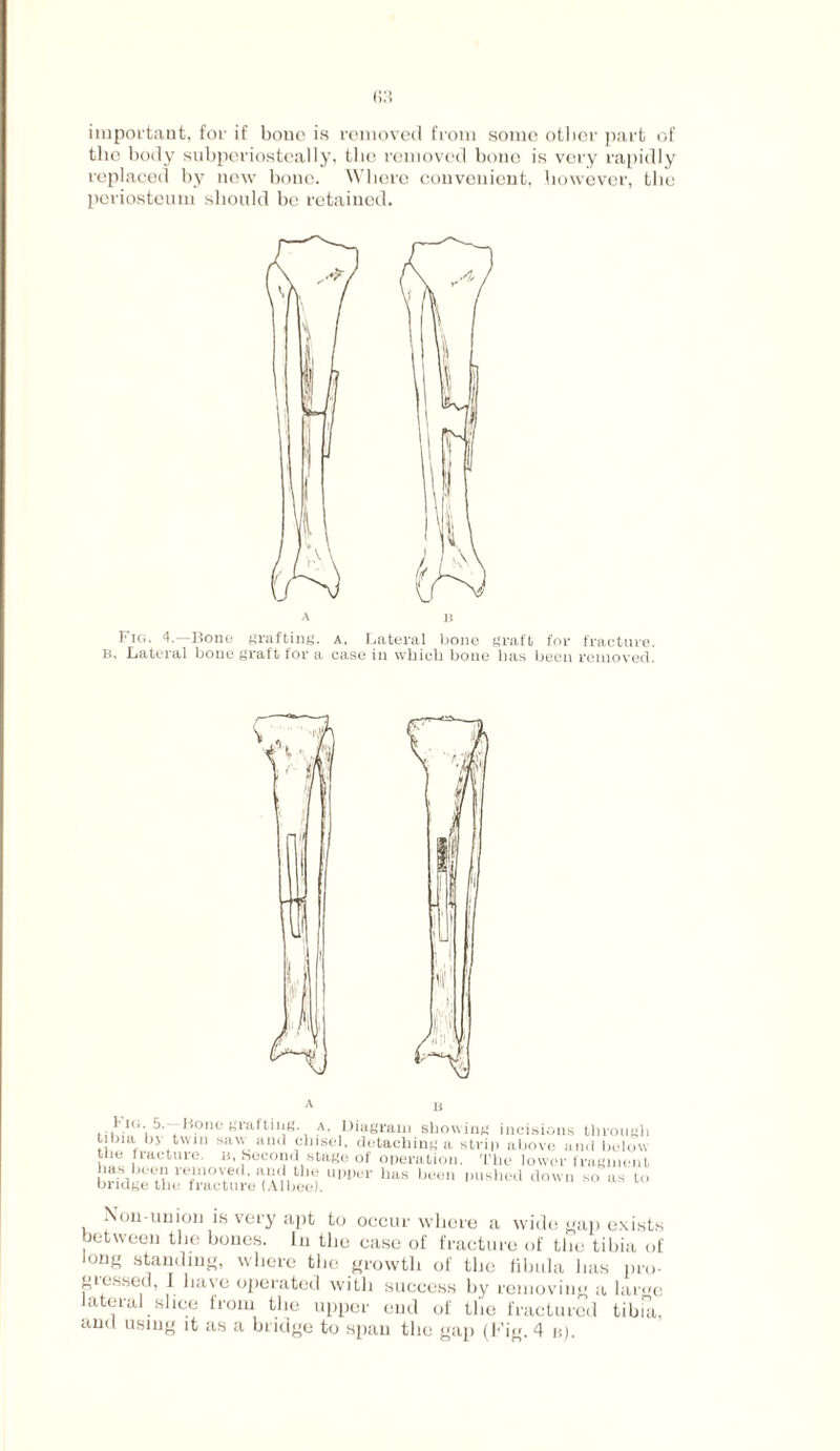 important, for if bone is removed from some other part of the body subperiosteally, the removed bone is very rapidly replaced by new bone. Where convenient, however, the periosteum should be retained. A li Fig. 4.—Bone grafting, a. Lateral bone graft for fracture. b, Lateral bone graft for a case in which bone has been removed. i i Hone giiiltnig. a, Diagram showing incisions through Ulna b> twin saw and chisel, detaching a strip above and below the line lure, n Second stage of operation. The lower fragment a^ heen removed, and the upper has been pushed down so ns to bridge the fracture (Albee). Non-union is very apt to occur where a wide gap exists between the bones. In the case of fracture of the tibia of long standing, where the growth of the fibula lias pro¬ gressed, I have operated with success by removing a lar<re lateral slice from the upper cud of the fractured tibia,