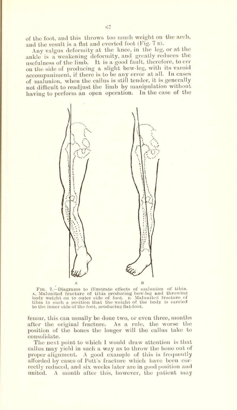 of the foot, ami this throws too much weight on the arch, and the result is a Hat aud everted foot (Fig. 7 n). Any valgus deformity at the knee, in the leg, or at the ankle is a weakening deformity, and greatly reduces the usefulness of the limb. It is a good fault, therefore, to err on the side of producing a slight bow-leg, with its varoid accompaniment, if there is to be any error at all. In cases of malunion, when the callus is still tender, it is generally not difficult to readjust the limb by manipulation without having to perform an open operation. In the case of the Fig. 7.—Diagrams to illustrate effects of malunion of tibia. a. Malunited fracture of tibia producing bow-leg and throwing body weight on to outer side of foot. b. Malunited fracture of tibia in such a position that the weight of the body is carried to the inner side of the foot, producing flat-foot. femur, this can usually be done two, or even three, months after the original fracture. As a rule, the worse the position of the bones the longer will the callus take to consolidate. The next point to which I would draw attention is that callus may yield in such a way as to throw the bone out of proper alignment. A good example of this is frequently afforded by cases of Pott’s fracture which have been cor¬ rectly reduced, and six weeks later are in good position and united. A mouth after this, however, the patient may