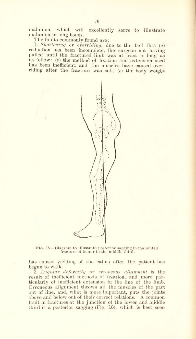 malunion, which will excellently serve to illustrate malunion in long bones. The faults commonly found are: 1. Shortening or overriding, due to the fact that (a) reduction has been incomplete, the surgeon not having pulled until the fractured limb was at least as long as its fellow; (b) the method of fixation and extension used has been inefficient, and the muscles have caused over¬ riding after the fracture was set; (c) the body weight Fig. 18.—Diagram to illustrate posterior sagging in malunitec! fracture of femur in the middle third. has caused yielding of the callus after the patient has begun to walk. 2. Angular deformity or erroneous alignment is the result of inefficient methods of fixation, and more par¬ ticularly of inefficient extension in the line of the limb. Erroneous alignment throws all the muscles of the part out of line, and, what is more important, puts the joints above and below out of their correct relations. A common fault in fractures at the junction of the lower and middle third is a posterior sagging (Fig. 18), which is best seen