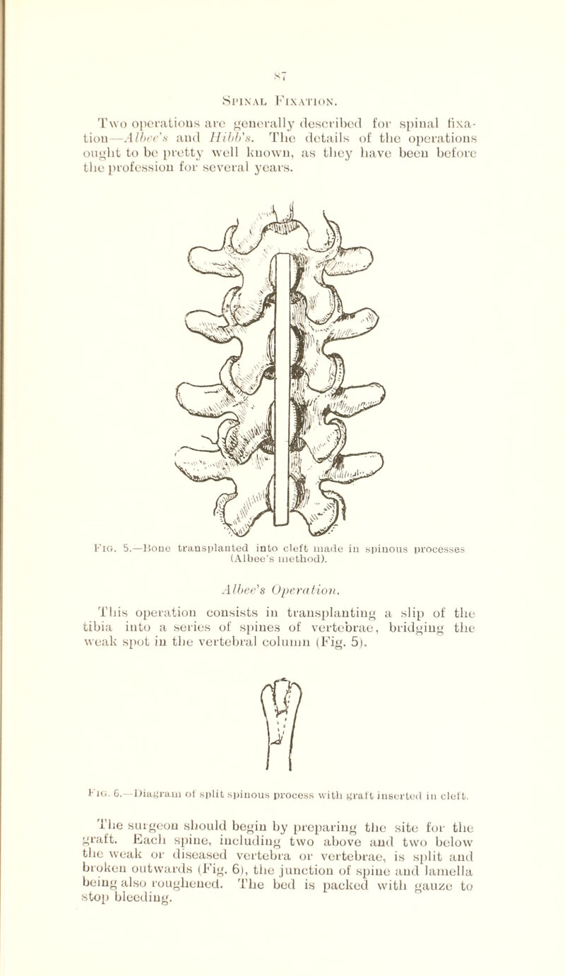 ST Spinal Fixation. Two operations are generally described for spinal fixa¬ tion—Albee's and Hibb's. The details of the operations ought to be pretty well known, as they have been before the profession for several years. Fig. 5.—Bone transplanted into cleft made in spinous processes (Albee’s method). Albee's Operation. This operation consists in transplanting a slip of the tibia into a series of spines of vertebrae, bridging the weak spot in the vertebral column (Fig. 5). Fm. Diagram of split spinous process with graft inserted in cleft. The siugeou should begin by preparing the site for the graft. Each spine, including two above and two below the weak or diseased vertebra or vertebrae, is split and broken outwards (Fig. 6), the junction of spine find lamella being also roughened. The bed is packed with gauze to stop bleeding.