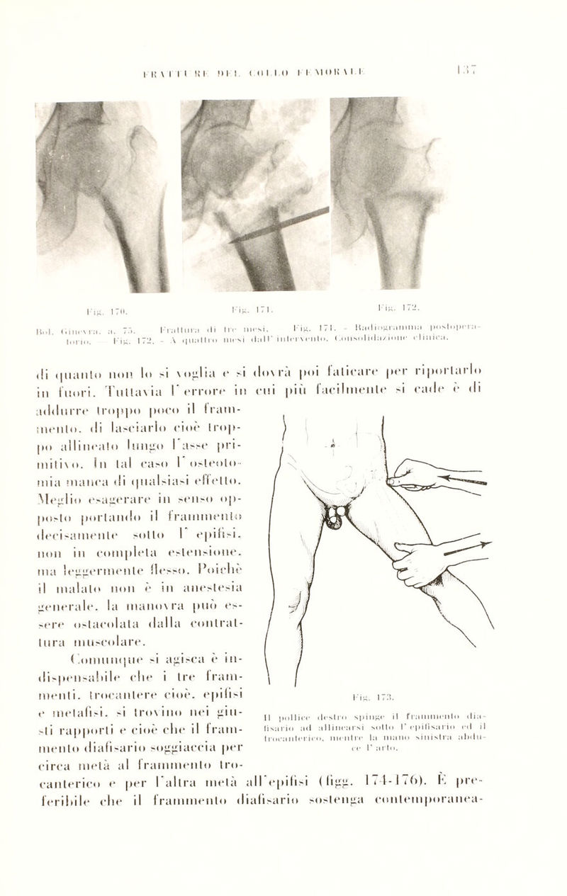 di quanto non lo si voglia e si in Inori. Tuttavia I errore in addurre troppo poco il frani- menlo. di lasciarlo cioè trop¬ po allineato Imipi I asse pri¬ mitivo. In tal caso I osteoto¬ mia manca di ipialsiasi citello. Meglio esagerare in senso op¬ posto portando il frammento decisamente sotto I epifisi. non in compieta estensione, ma leggermente (lesso. Poiché il maialo non è in anestesia generale, la manovra può es¬ sere ostacolata dalla contrat¬ tura muscolare. ( .onumque si agisca è in¬ dispensabile elle i tre I ram¬ menti. trocantere cioè, epifisi e melalisi, -i trovino nei giu¬ sti rapporti e cioè clic il fram¬ mento dialisario soggiaccia per circa metà al frammento tro- canterico e per I altra mela feribile che il frammento d dovrà poi faticare per riportarlo cui più facilmente si cade è di Il pollice desilo spinge il frammento dia- Il ssi rio ad allinearsi salto V epifisario ed il Iroeanterieo, rneidre la inano sinistra alalo- P urto. al Pepi lisi ( ligg. I* i-l iù). K pre- ialisario sostenga contemporanea-