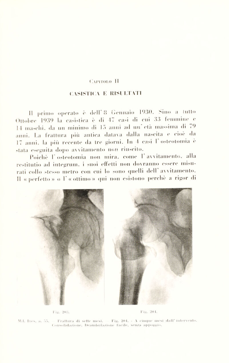 cvsisti<:\ i: msi itati || |)i*i11io operalo è (irli d Gennaio 1930. Sino a mito Ottobre 1939 la cadisi ira è di l( casi di cui 33 Irmmiiic c 14 uniscili, da un minimo di 13 anni ad un eia massima di 79 anni. La frattura più aulica «Ialina dalla nascila r cioè da 17 anni, la più recente da Ire giorni. In 4 casi I osteotomia è «lata eseguila dopo avvitamento non riuscito. Poiché I osteotomia non mira, come I awilamenlo, alla reMilutio ad integrimi. i suoi efletli non dovranno essere misu¬ rati collo stesso metro con cui lo sono quelli dell avvitamento. Il «perielio)) o I « ottimo » «pii non esistono perchè a rigor di 20.4. l ii;. 20 1. Fruttimi di ( 4 h i s o I i < I ; i / i « m < *. sdir Illesi. Fi#. 20 I. I )r;tml>ii hi/, ione Ine ile. - \ rimine mesi senza ;ippo#j;io. dii IT inteiN etlln. Mil. Ines. n.