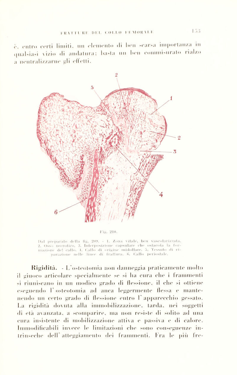 >. oiilro crrli limili, mi t'Idiidilo di lidi >cai'sa importanza in 111;11-i;i-i \ i/io di il11<l:i111ra ; Iia-1 a un lidi commisurato rialzo i nonIralizzarue fili (‘Urlìi. 2 ri. 2ui. 2 Dal preparato (Iella li£. 20fL - 1. Zona vitale, ben vascolnri/zata. 2. Oss i necrotico. A. Interposi/ione capsulare clic ostacola la l’or- inazioni dei callo. I. (.allo di origine midollare. •>. lessalo di ri¬ parazione nelle linee di frattura. <>. (.allo periostale. Iti gidilà. - Losteotomia non danneggia praticamente mollo il giuoco articolare specialmente >e >i lui cura clic i frammenti -i riuniscano in un modico grillili ili flessione, il clic >i olliene eseguendo I osteotomia ad anca leggermente flessa (‘ manle- ncmlo un cerio gradii di llessione enlrii 1 a|i|iarecchio gessalo. La rigidità dowila alla immoliilizzazione. larda, nei suggelli di età avanzala, a scomparire, ma non resiste ili solilo ad una cura insLtenle ili molli li/,za/.ione adiva <“ passiva e ili calore. Immodificaliili invece le limilazioni clic Mino conseguenze in- lrin>eclie dell alleggiamenlo dei frammenti. Fra lt‘ più Ire-