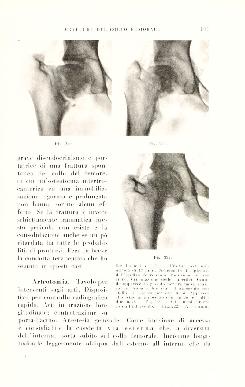 <ira\e uiseuuocnuismo e por¬ tatrice di una trattura spon¬ tanea del collo del lemure, in cui un osteotomia interlro- canterica ed una immobiliz¬ zazione rigorosa e prolungala non hanno sortito alcun el - letto. Se la trattura è invece schiettamente traumatica <pie- sto pericolo non esiste e la co uso lid azione anche se un pò ritardata ha tutte le probabi¬ lità di prodursi. Ecco in breve la condotta terapeutica che ho seguito in questi casi : Artrolomia. - Tavolo per inler\enti siigli arti. Disposi¬ le o per conlridlo radiografico rapido. \rti in trazione lon¬ gitudinale: controlrazione su porta-bacino, \neslesia generale. (Ionie incisione di accesso è consigliabile la cosidelta \ ia esterna che, a diversità dell interna, porla subito sul collo lemorale. Incisione longi¬ tudinale le^fiermenle oldiipia dall esterno all interno elle da Slr. bimiciiicn. ;i. 2(). I*r<i1111rii tivv 'tiulit iiir e tà di 17 titilli. Pseudoartrosi c picnosi (leir epifisi. Arlrolomiii. Hiduzione in It ti /ione. ( jucntaxionc delle stiperlici. (■ i*n11- de apparecchio Vessillo per tre mesi, scn/a carico. Apparecch io sino ;d ginocchio con stilili» di scarico per due mesi. Apparec¬ chio sino jil ginocchio con carico per altri due mesi. I i^;. 221. - A Ire mesi e mez¬ zo dii 1 Tintervento. l'i^. 222. - A sei anni.