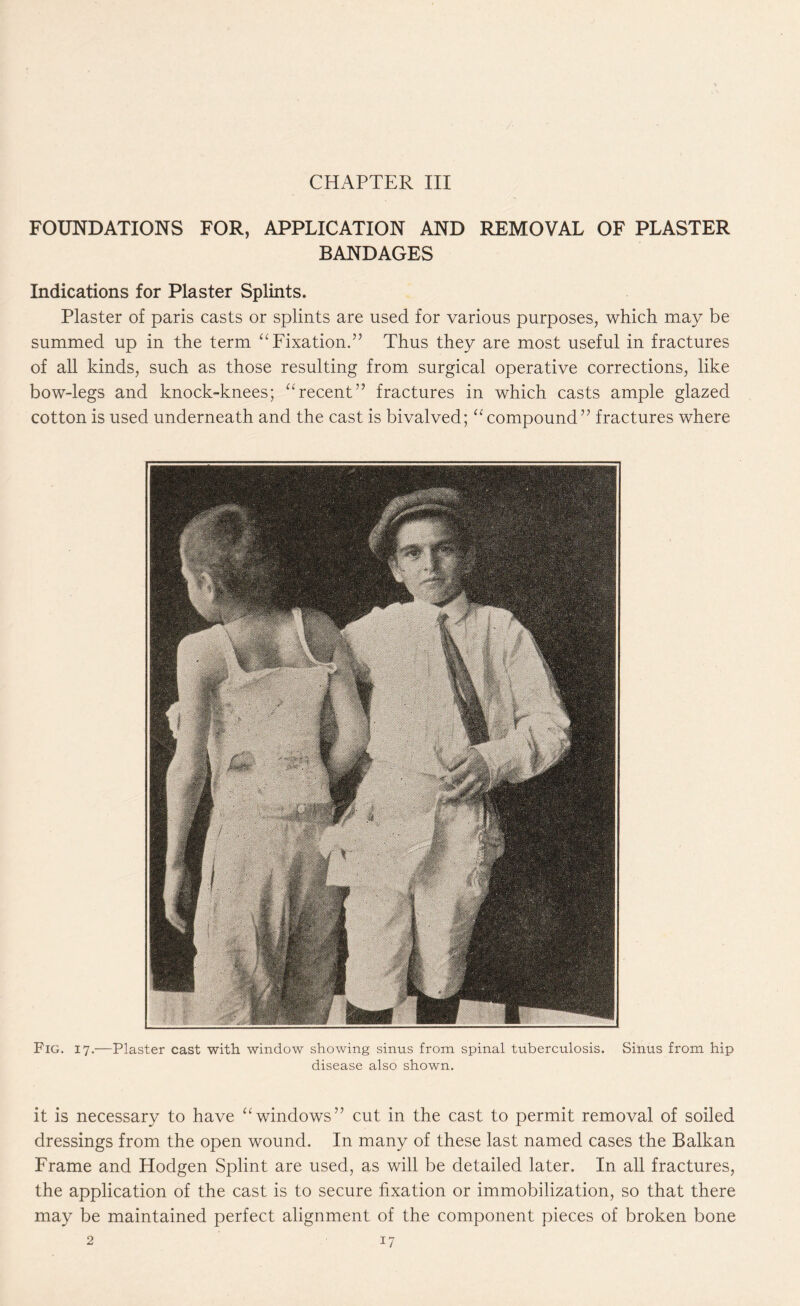 Fig. 17.—Plaster cast with window showing sinus from spinal tuberculosis. Sinus from hip disease also shown. it is necessary to have “ windows” cut in the cast to permit removal of soiled dressings from the open wound. In many of these last named cases the Balkan Frame and Hodgen Splint are used, as will be detailed later. In all fractures, the application of the cast is to secure fixation or immobilization, so that there may be maintained perfect alignment of the component pieces of broken bone 2 17 FOUNDATIONS FOR, APPLICATION AND REMOVAL OF PLASTER BANDAGES Indications for Plaster Splints. Plaster of paris casts or splints are used for various purposes, which may be summed up in the term “ Fixation.” Thus they are most useful in fractures of all kinds, such as those resulting from surgical operative corrections, like bow-legs and knock-knees; 11 recent” fractures in which casts ample glazed cotton is used underneath and the cast is bivalved; “compound” fractures where