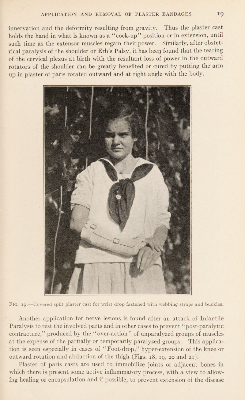 innervation and the deformity resulting from gravity. Thus the plaster cast holds the hand in what is known as a “cock-up” position or in extension, until such time as the extensor muscles regain their power. Similarly, after obstet¬ rical paralysis of the shoulder or Erb’s Palsy, it has been found that the tearing of the cervical plexus at birth with the resultant loss of power in the outward rotators of the shoulder can be greatly benefited or cured by putting the arm up in plaster of paris rotated outward and at right angle with the body. Fig. 19.—Covered split plaster cast for wrist drop fastened with webbing straps and buckles. Another application for nerve lesions is found after an attack of Infantile Paralysis to rest the involved parts and in other cases to prevent “post-paralytic contracture,” produced by the “over-action” of unparalyzed groups of muscles at the expense of the partially or temporarily paralyzed groups. This applica¬ tion is seen especially in cases of “Foot-drop,” hyper-extension of the knee or outward rotation and abduction of the thigh (Figs. 18, 19, 20 and 21). Plaster of paris casts are used to immobilize joints or adjacent bones in which there is present some active inflammatory process, with a view to allow¬ ing healing or encapsulation and if possible, to prevent extension of the disease
