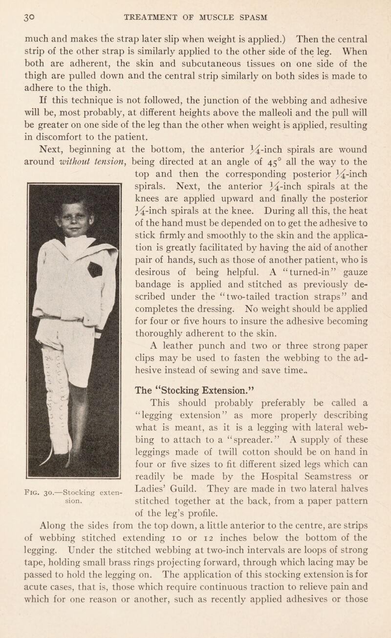 much and makes the strap later slip when weight is applied.) Then the central strip of the other strap is similarly applied to the other side of the leg. When both are adherent, the skin and subcutaneous tissues on one side of the thigh are pulled down and the central strip similarly on both sides is made to adhere to the thigh. If this technique is not followed, the junction of the webbing and adhesive will be, most probably, at different heights above the malleoli and the pull will be greater on one side of the leg than the other when weight is applied, resulting in discomfort to the patient. Next, beginning at the bottom, the anterior J^-inch spirals are wound around without tension, being directed at an angle of 45 ° all the way to the top and then the corresponding posterior y^-mch spirals. Next, the anterior }4-indi spirals at the knees are applied upward and finally the posterior I^-inch spirals at the knee. During all this, the heat of the hand must be depended on to get the adhesive to stick firmly and smoothly to the skin and the applica¬ tion is greatly facilitated by having the aid of another pair of hands, such as those of another patient, who is desirous of being helpful. A “ turned-in” gauze bandage is applied and stitched as previously de¬ scribed under the “two-tailed traction straps” and completes the dressing. No weight should be applied for four or five hours to insure the adhesive becoming thoroughly adherent to the skin. A leather punch and two or three strong paper clips may be used to fasten the webbing to the ad¬ hesive instead of sewing and save time.. The “Stocking Extension.” This should probably preferably be called a “legging extension” as more properly describing what is meant, as it is a legging with lateral web¬ bing to attach to a “spreader.” A supply of these leggings made of twill cotton should be on hand in four or five sizes to fit different sized legs which can readily be made by the Hospital Seamstress or Ladies’ Guild. They are made in two lateral halves stitched together at the back, from a paper pattern of the leg’s profile. Along the sides from the top down, a little anterior to the centre, are strips of webbing stitched extending 10 or 12 inches below the bottom of the legging. Under the stitched webbing at two-inch intervals are loops of strong tape, holding small brass rings projecting forward, through which lacing may be passed to hold the legging on. The application of this stocking extension is for acute cases, that is, those which require continuous traction to relieve pain and which for one reason or another, such as recently applied adhesives or those -Stocking exten¬ sion.