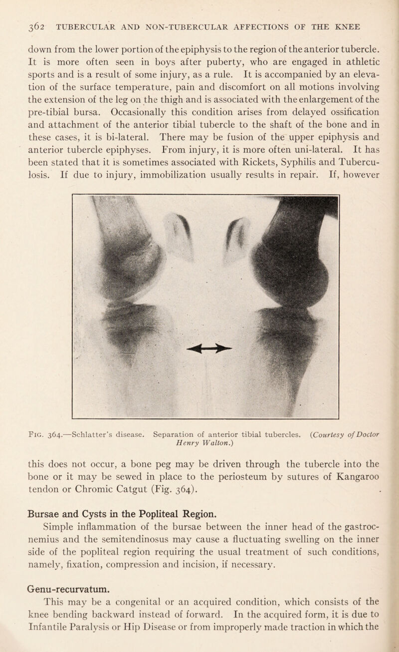 down from the lower portion of the epiphysis to the region of the anterior tubercle. It is more often seen in boys after puberty, who are engaged in athletic sports and is a result of some injury, as a rule. It is accompanied by an eleva¬ tion of the surface temperature, pain and discomfort on all motions involving the extension of the leg on the thigh and is associated with the enlargement of the pre-tibial bursa. Occasionally this condition arises from delayed ossification and attachment of the anterior tibial tubercle to the shaft of the bone and in these cases, it is bi-lateral. There may be fusion of the upper epiphysis and anterior tubercle epiphyses. From injury, it is more often uni-lateral. It has been stated that it is sometimes associated with Rickets, Syphilis and Tubercu¬ losis. If due to injury, immobilization usually results in repair. If, however Fig. 364.—Schlatter’s disease. Separation of anterior tibial tubercles. (Courtesy of Doctor Henry Walton.) this does not occur, a bone peg may be driven through the tubercle into the bone or it may be sewed in place to the periosteum by sutures of Kangaroo tendon or Chromic Catgut (Fig. 364). Bursae and Cysts in the Popliteal Region. Simple inflammation of the bursae between the inner head of the gastroc¬ nemius and the semitendinosus may cause a fluctuating swelling on the inner side of the popliteal region requiring the usual treatment of such conditions, namely, fixation, compression and incision, if necessary. Genu-recurvatum. This may be a congenital or an acquired condition, which consists of the knee bending backward instead of forward. In the acquired form, it is due to Infantile Paralysis or Hip Disease or from improperly made traction in which the