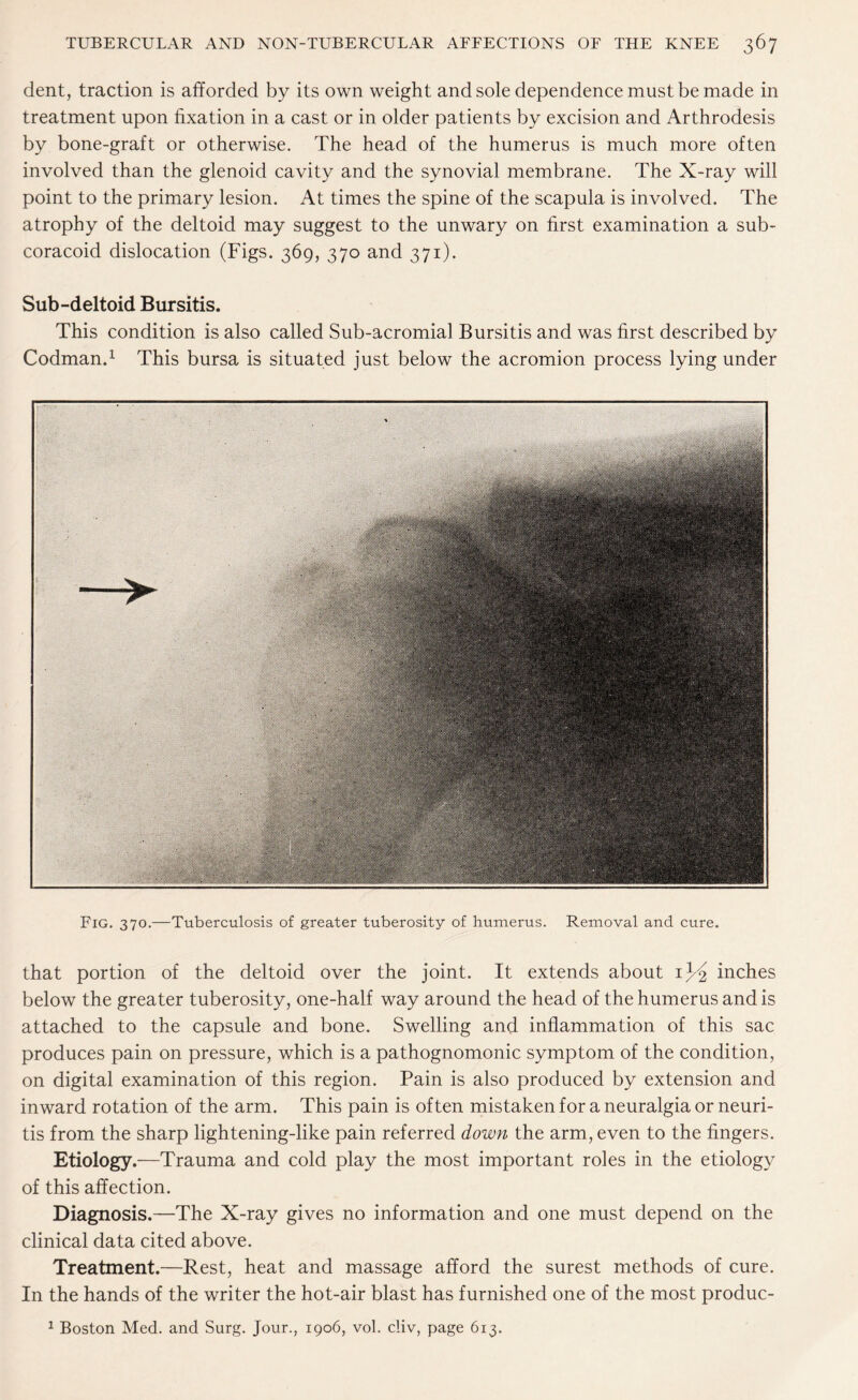 dent, traction is afforded by its own weight and sole dependence must be made in treatment upon fixation in a cast or in older patients by excision and Arthrodesis by bone-graft or otherwise. The head of the humerus is much more often involved than the glenoid cavity and the synovial membrane. The X-ray will point to the primary lesion. At times the spine of the scapula is involved. The atrophy of the deltoid may suggest to the unwary on first examination a sub¬ coracoid dislocation (Figs. 369, 370 and 371). Sub-deltoid Bursitis. This condition is also called Sub-acromial Bursitis and was first described by Codman.1 This bursa is situated just below the acromion process lying under Fig. 370.—Tuberculosis of greater tuberosity of humerus. Removal and cure. that portion of the deltoid over the joint. It extends about 1^2 inches below the greater tuberosity, one-half way around the head of the humerus and is attached to the capsule and bone. Swelling and inflammation of this sac produces pain on pressure, which is a pathognomonic symptom of the condition, on digital examination of this region. Pain is also produced by extension and inward rotation of the arm. This pain is often mistaken for a neuralgia or neuri¬ tis from the sharp lightening-like pain referred down the arm, even to the fingers. Etiology.—Trauma and cold play the most important roles in the etiology of this affection. Diagnosis.—The X-ray gives no information and one must depend on the clinical data cited above. Treatment.—Rest, heat and massage afford the surest methods of cure. In the hands of the writer the hot-air blast has furnished one of the most produc- 1 Boston Med. and Surg. Jour., 1906, vol. cliv, page 613.