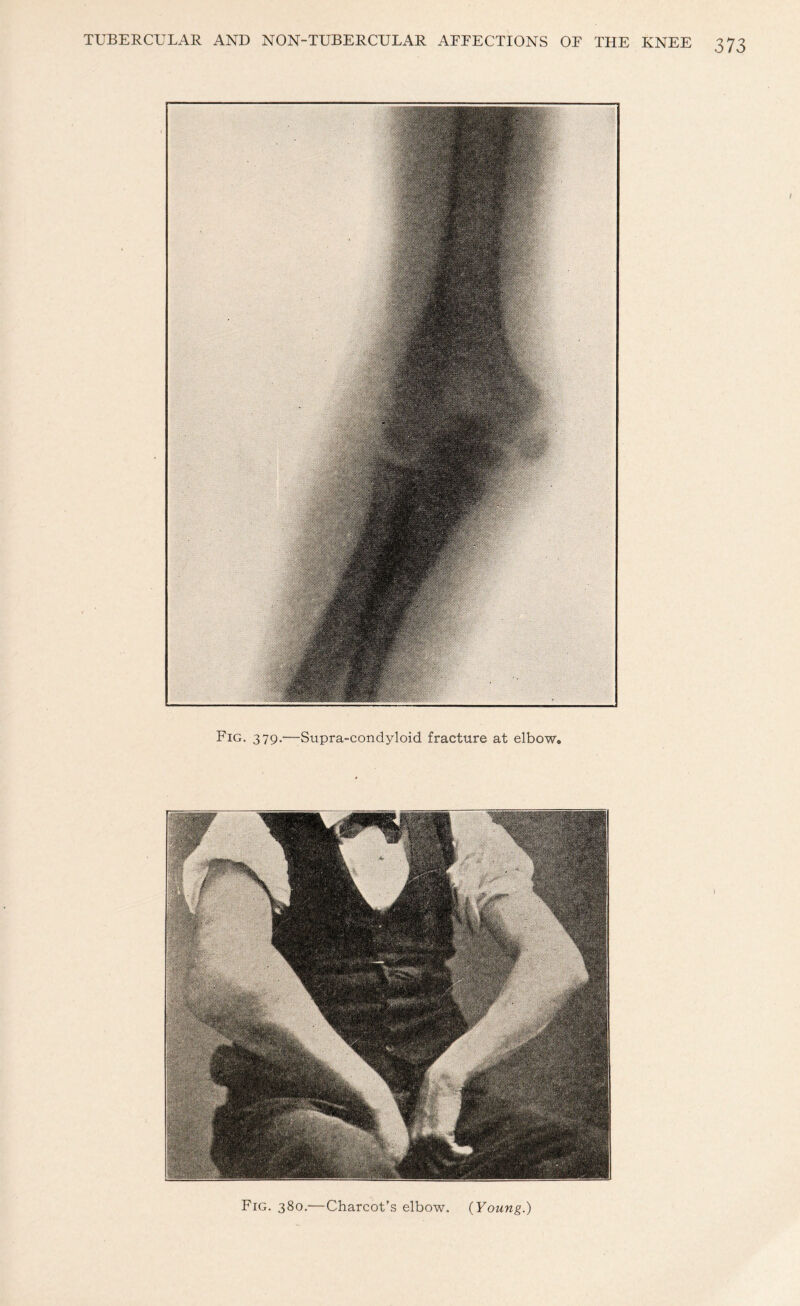 Fig. 379.—Supra-condyloid fracture at elbow* Fig. 380.—Charcot’s elbow. {Young.)